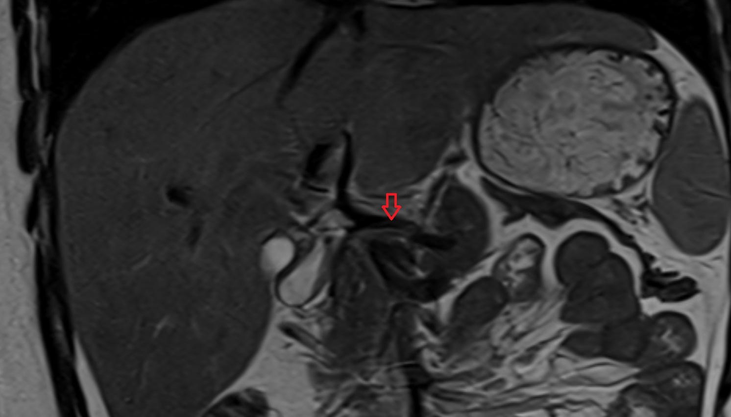 common hepatic artery anantomy MRI CORONAL  image -img-00000-00000