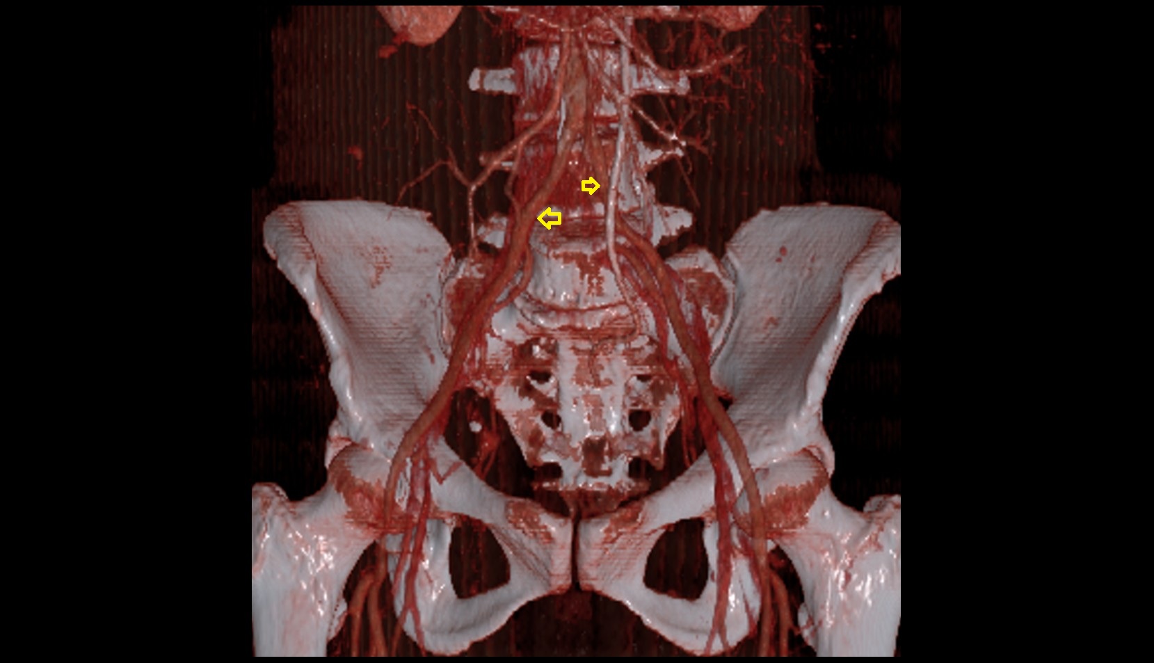 common iliac artery 3d ct image