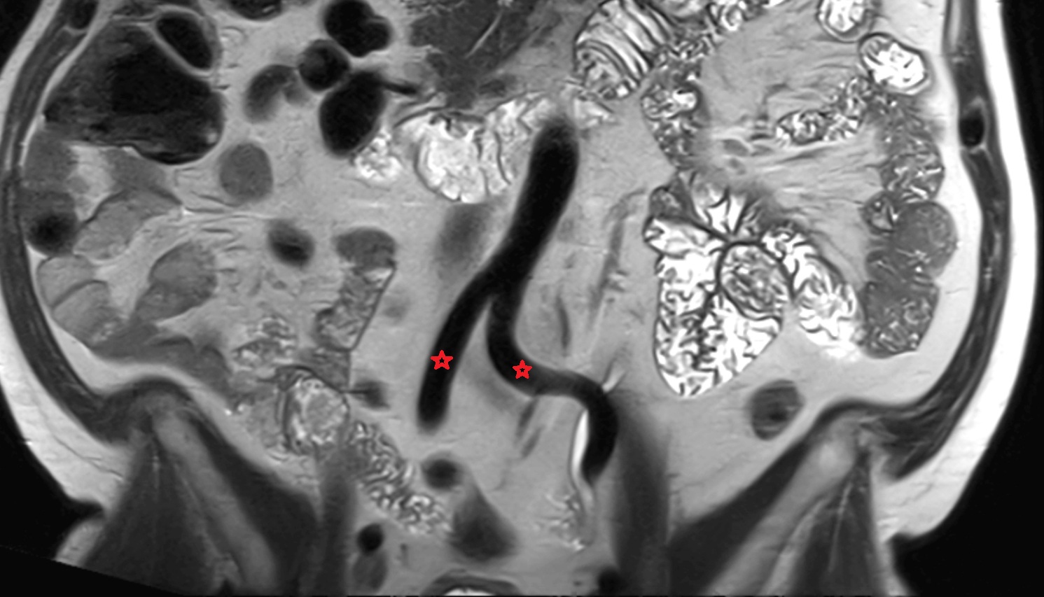 common iliac artery   MRI   coronal anatomy  image-img-00000-00000