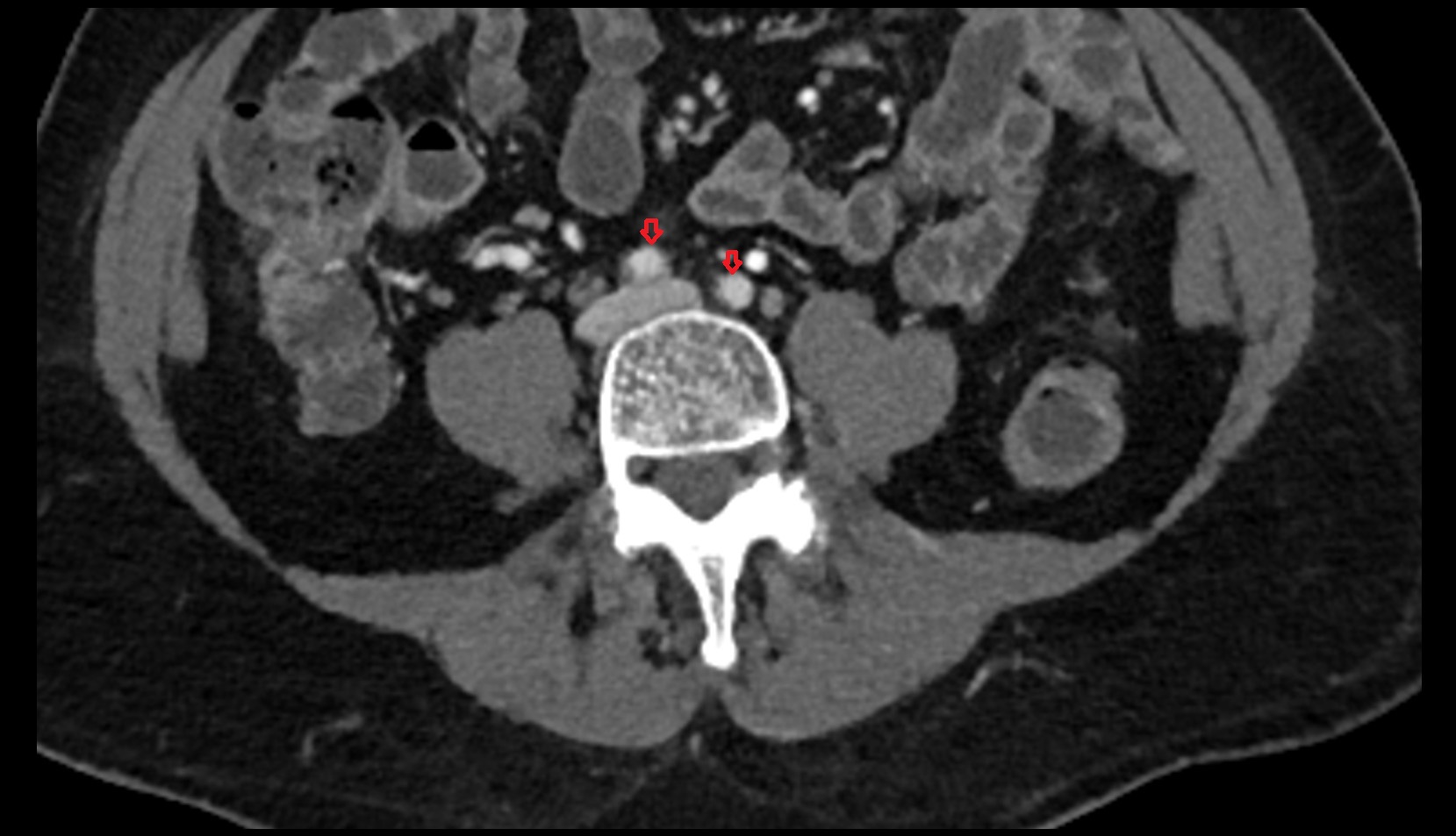 common iliac artery ct axial