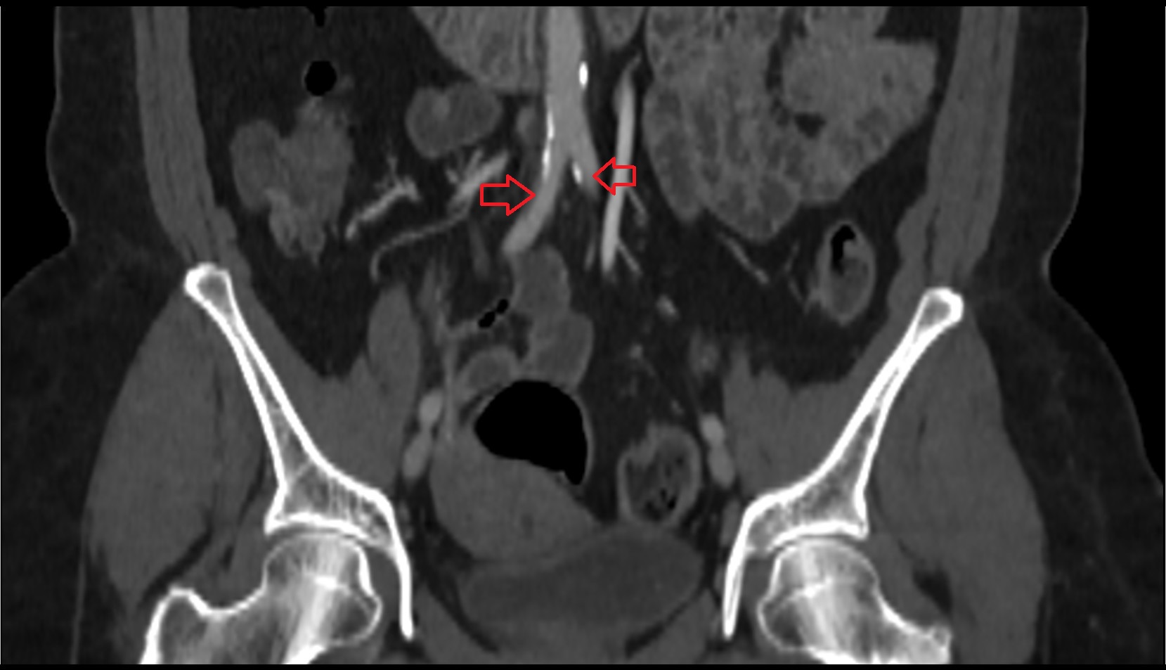 common iliac artery ct coronal image