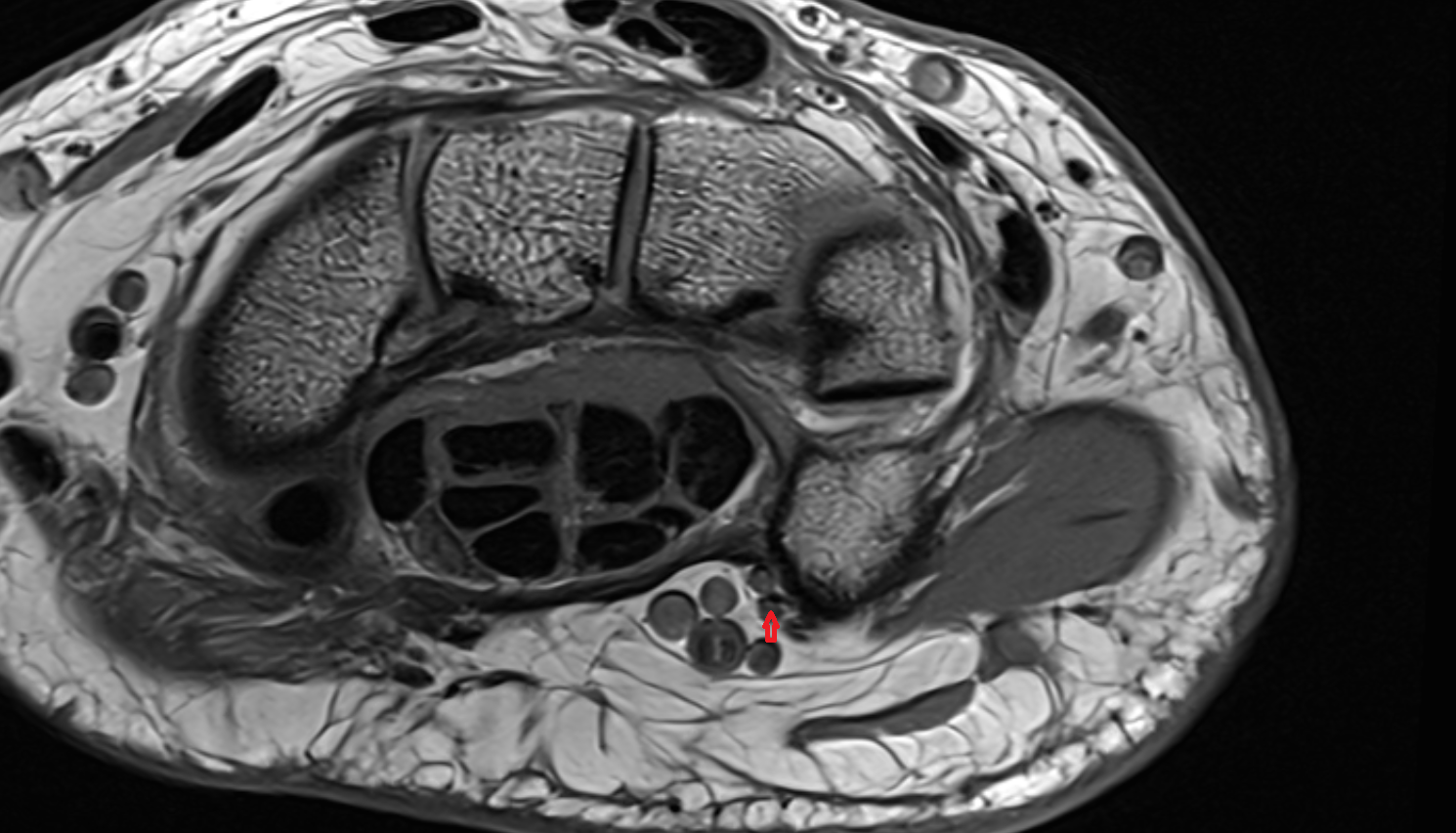 common palmar digital branch of ulnar nerve axial cross sectional anatomy 3T MRI AI enhanced radiology image-img-00000-00000