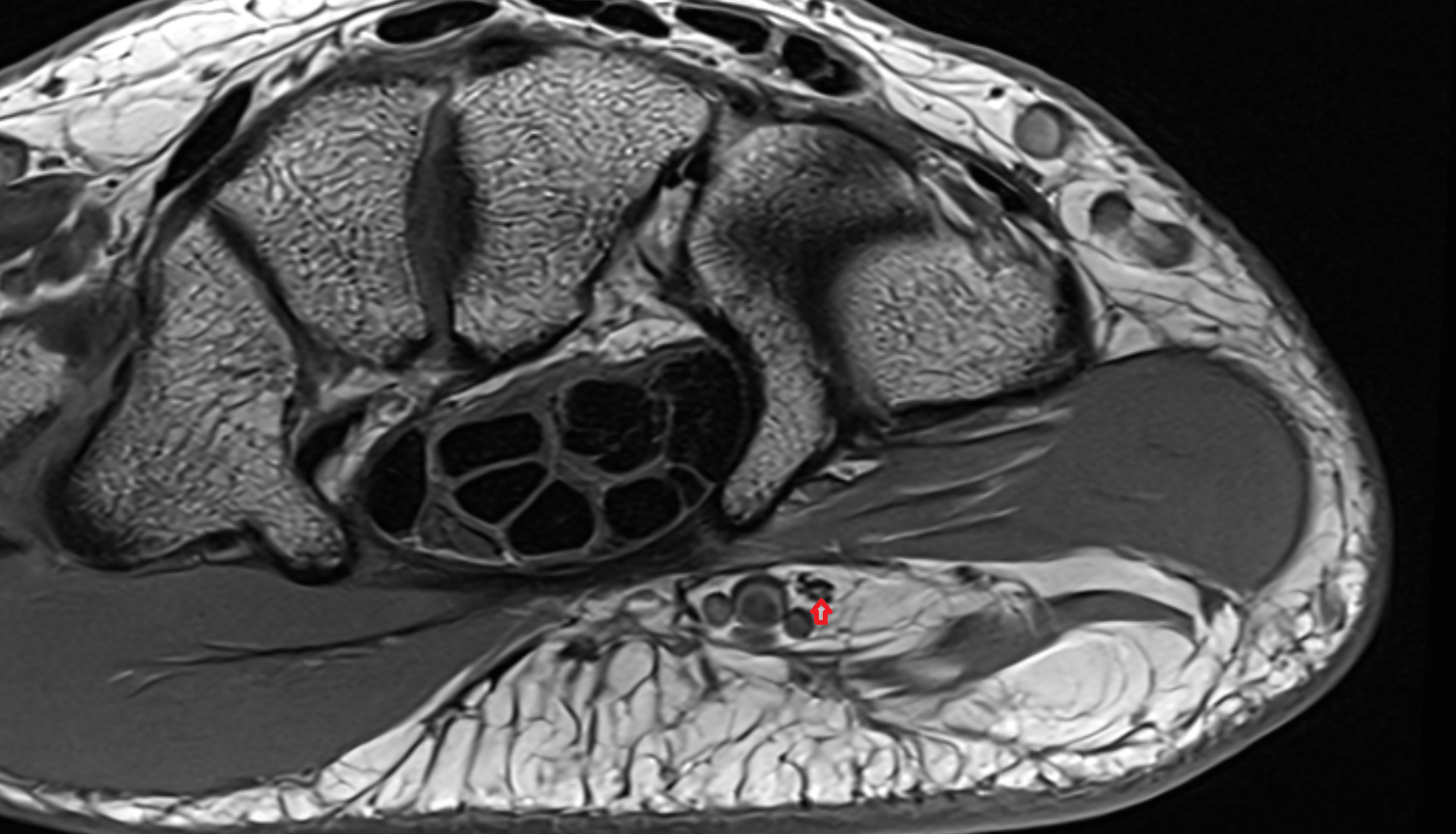 common palmar digital branch of ulnar nerve axial cross sectional anatomy 3T MRI AI enhanced radiology image-img-00000-00000_00001