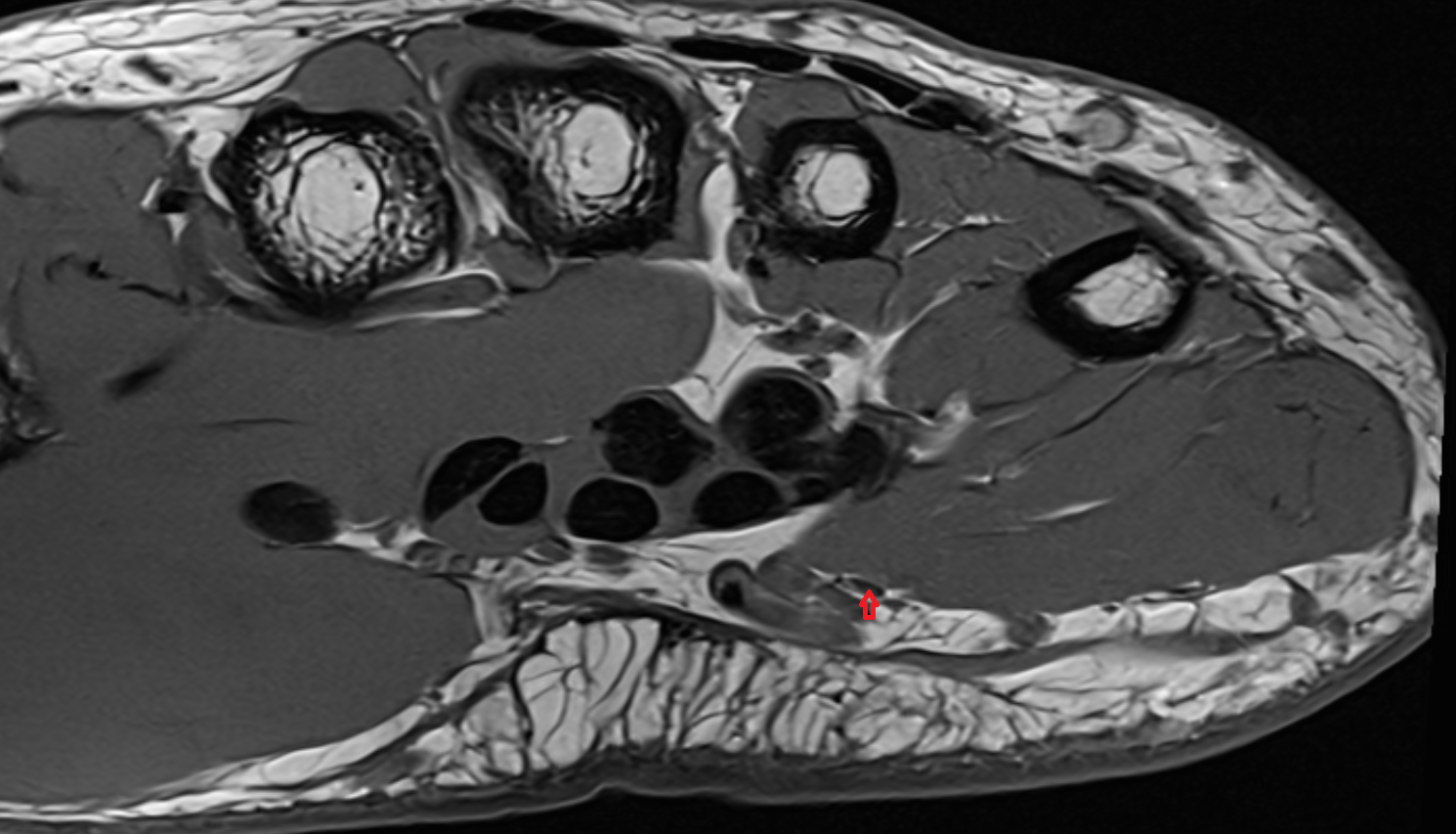 common palmar digital branch of ulnar nerve axial cross sectional anatomy 3T MRI AI enhanced radiology image-img-00000-00000_00002