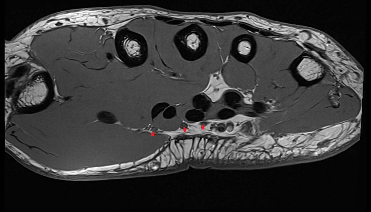 common palmar digital nerves of median nerve axial cross sectional anatomy 3T MRI AI enhanced radiology image-img-00000-00000_00001