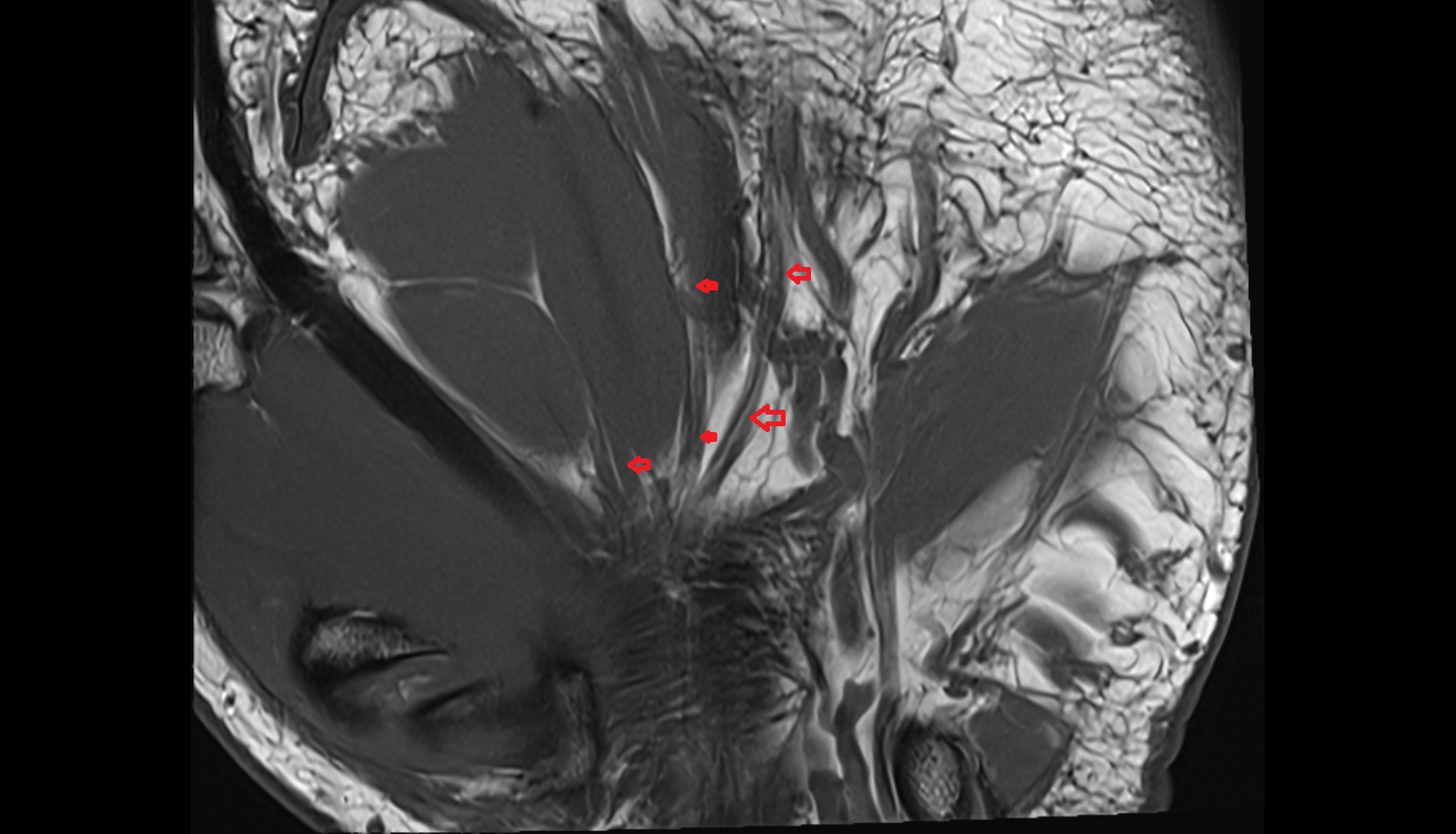 common palmar digital nerves of median nerve coronal cross sectional anatomy 3T MRI AI enhanced radiology image-img-00000-00000