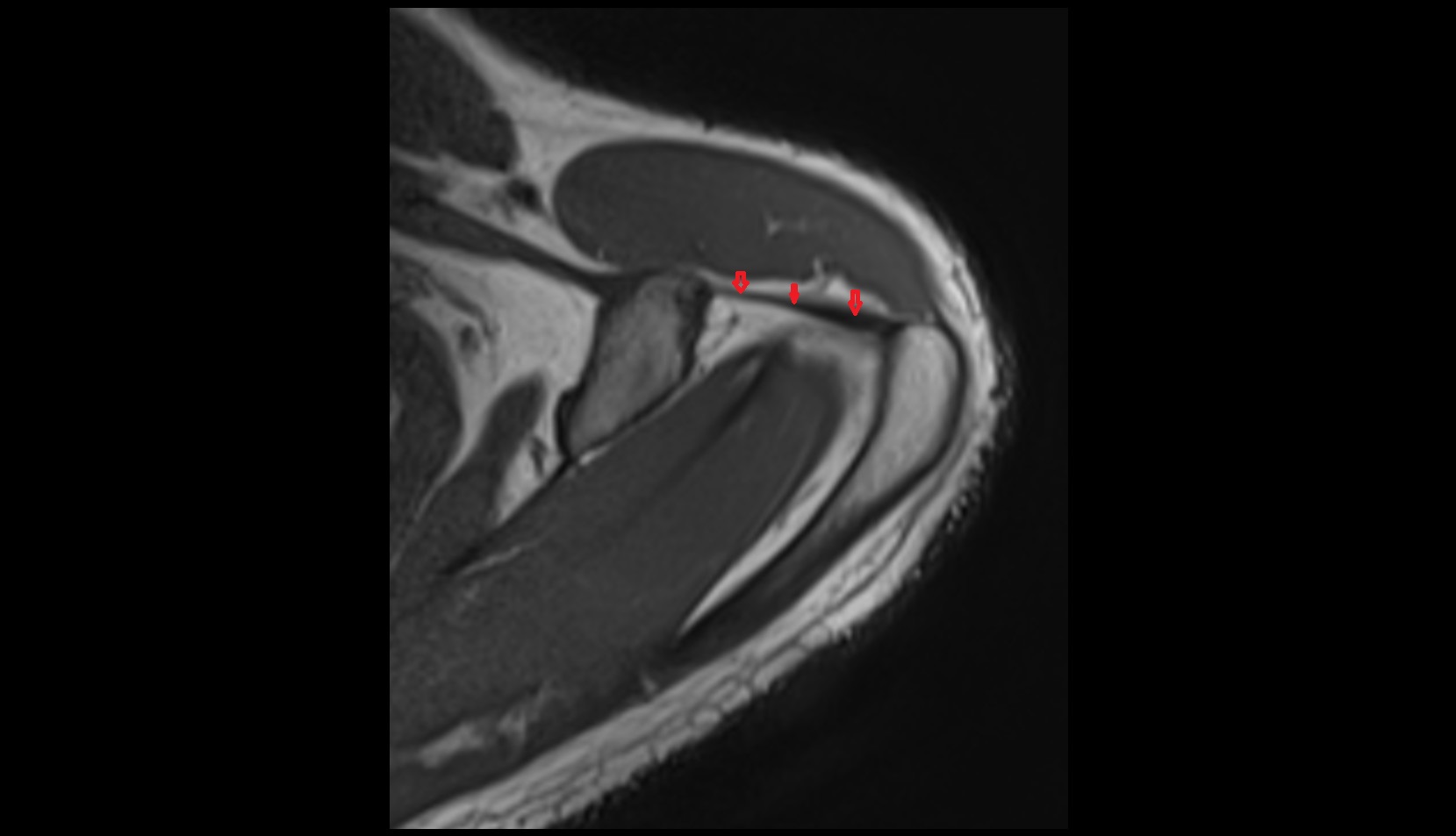 coracoacromial ligament MRI 3D 1MM AXIAL IMAGE