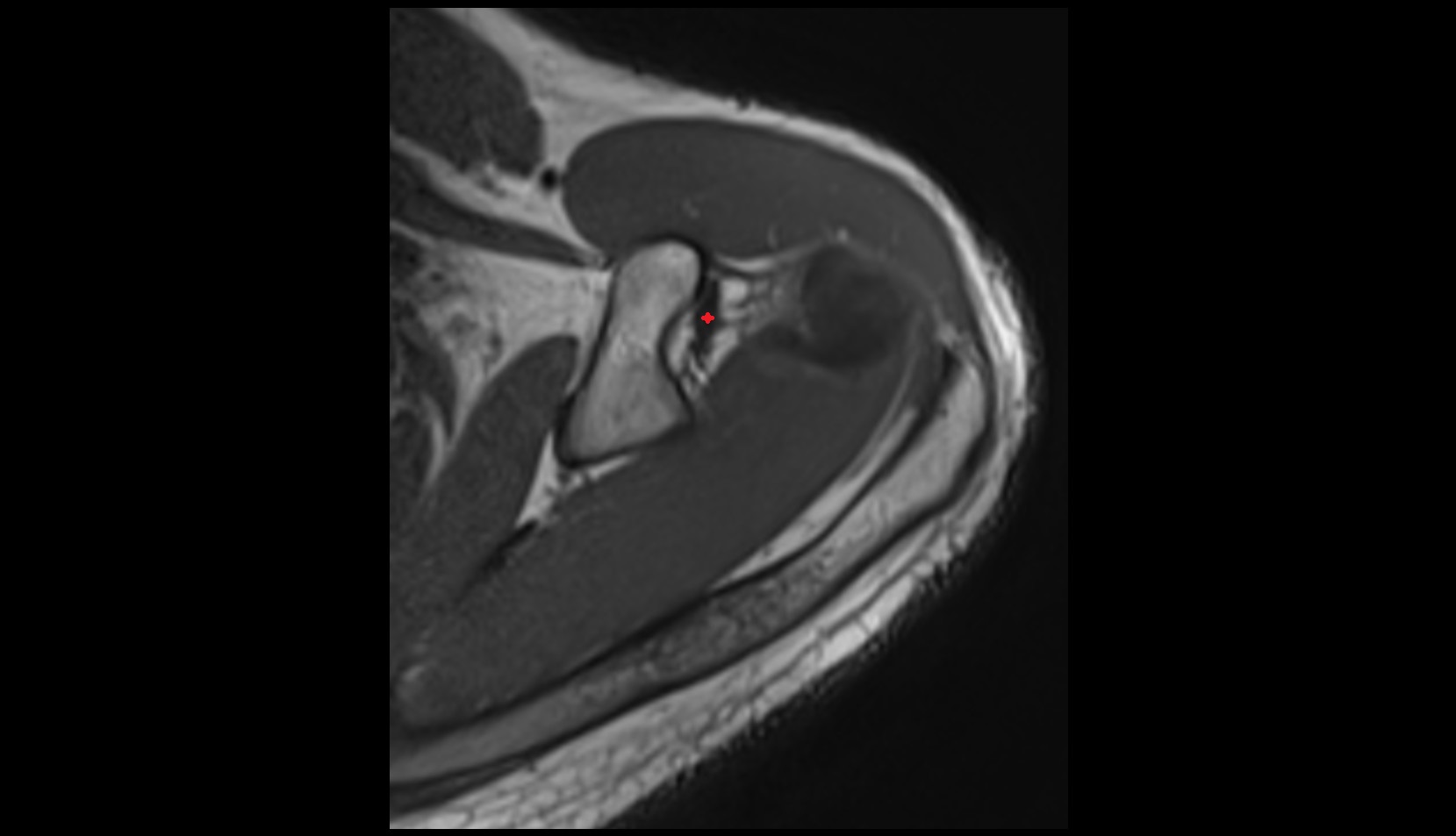 coracohumeral ligament 3D MRI AXIAL IMAGE