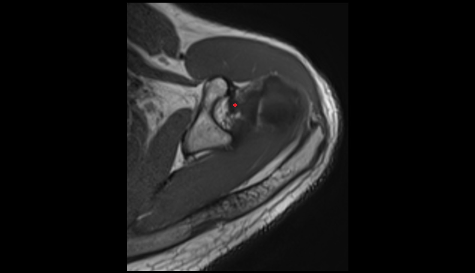coracohumeral ligament 3D MRI AXIAL IMAGE 2