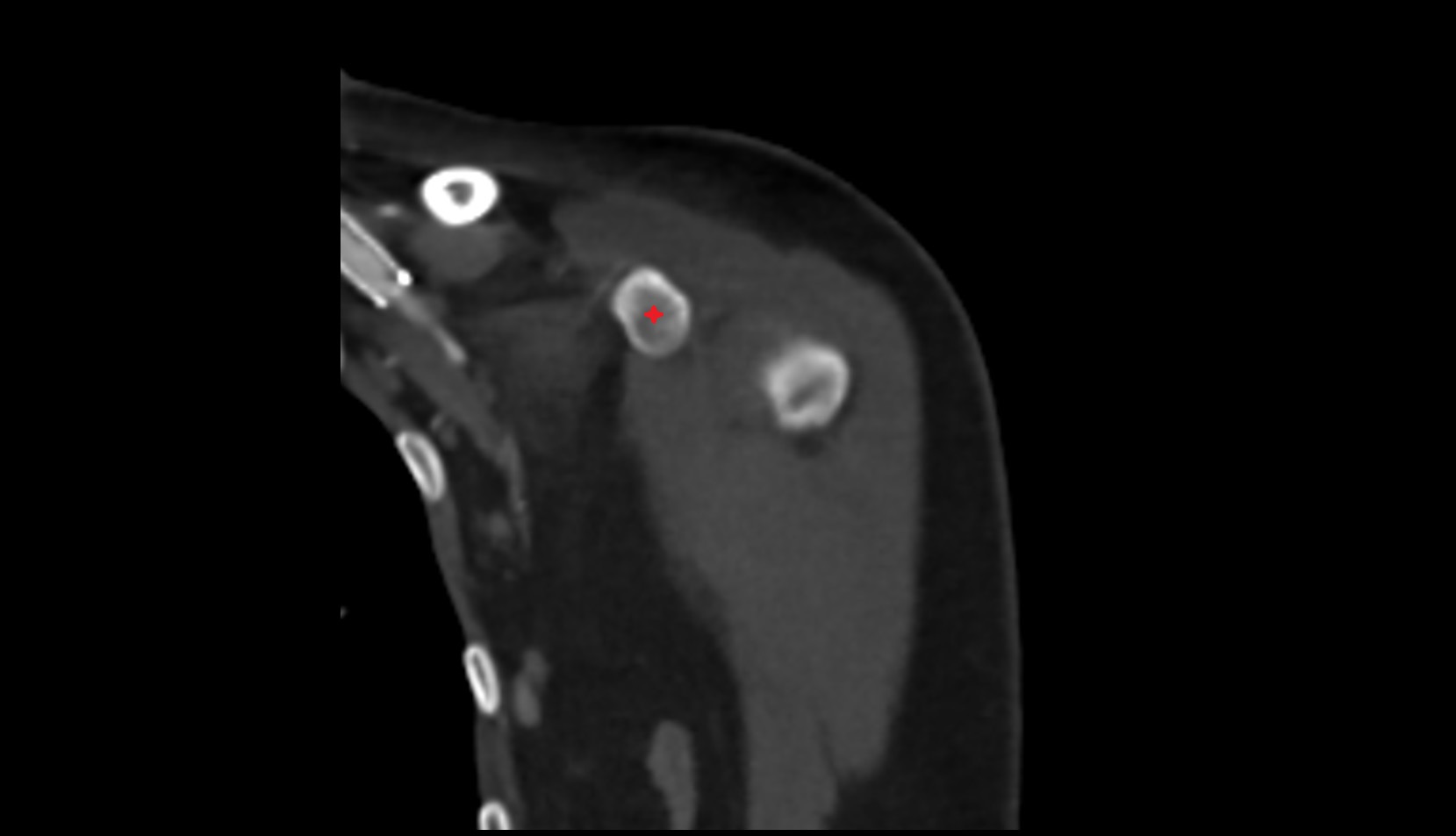 coracoid process of scapula coronal ct image