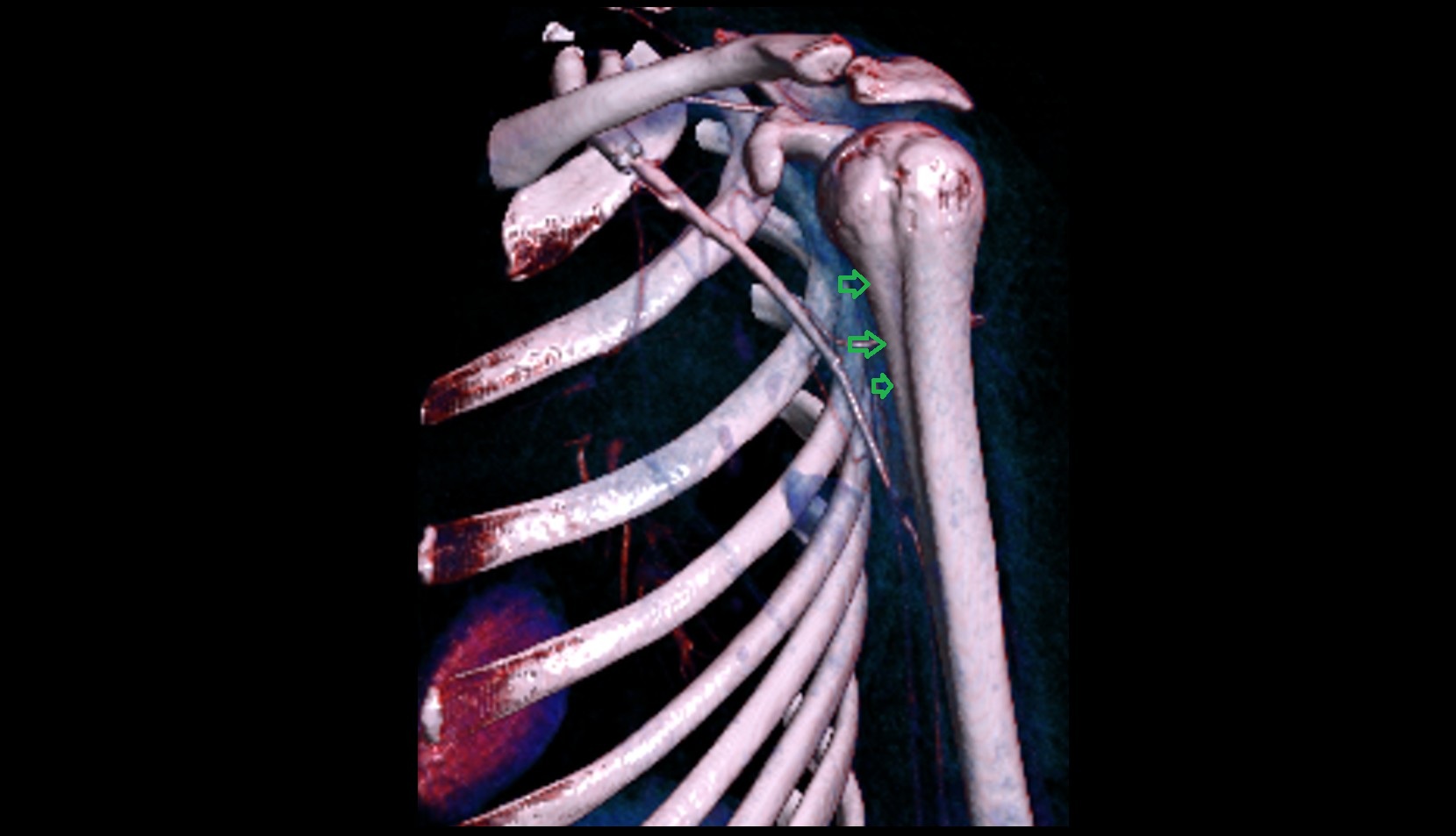 crest of lesser tubercle 3d