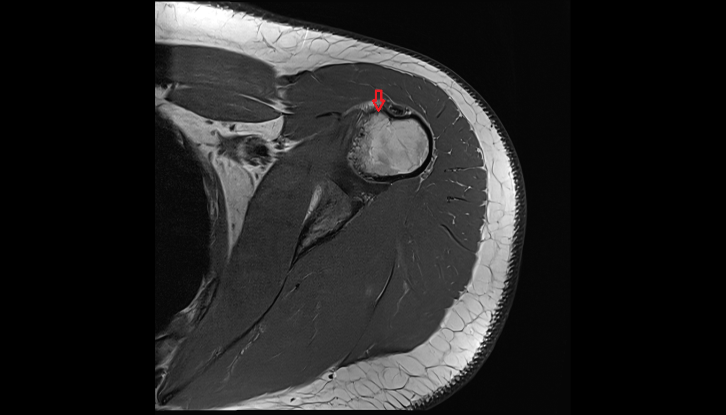 crest of lesser tubercle  mri anatomy labelled image-img-00000-00000
