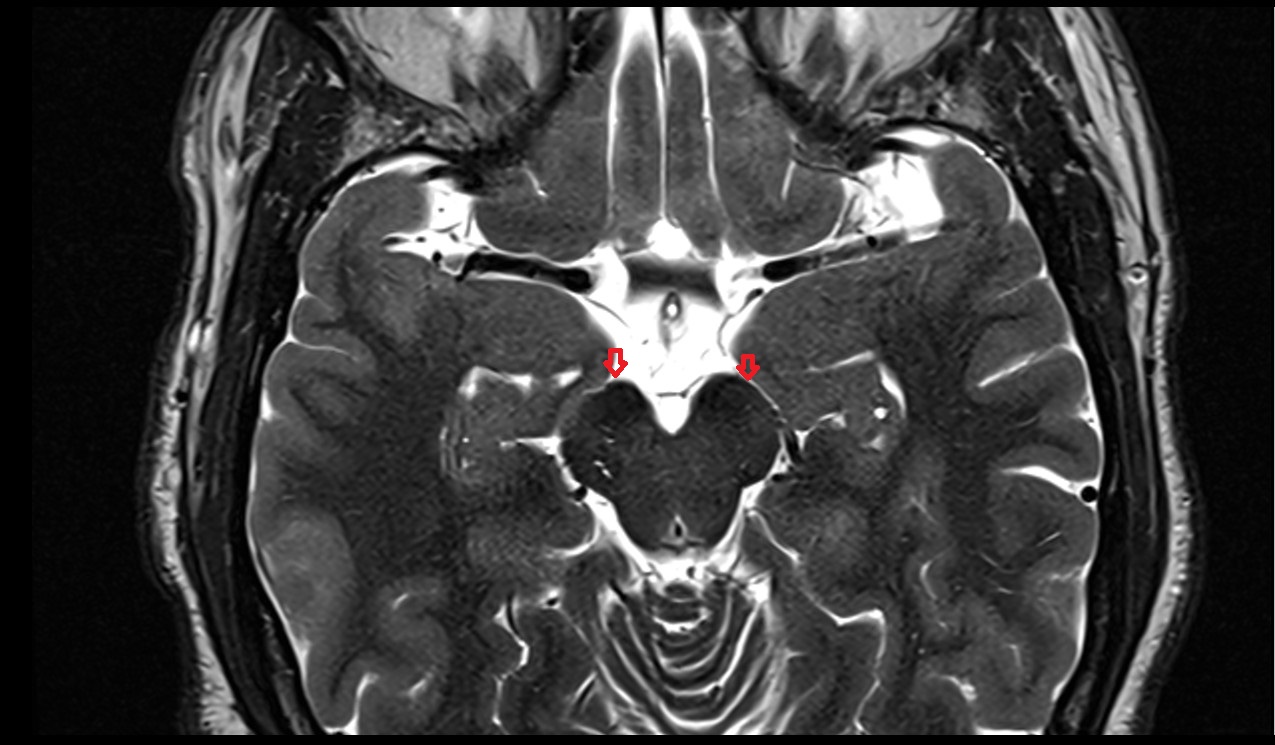 crural cistern mri 3t axial image