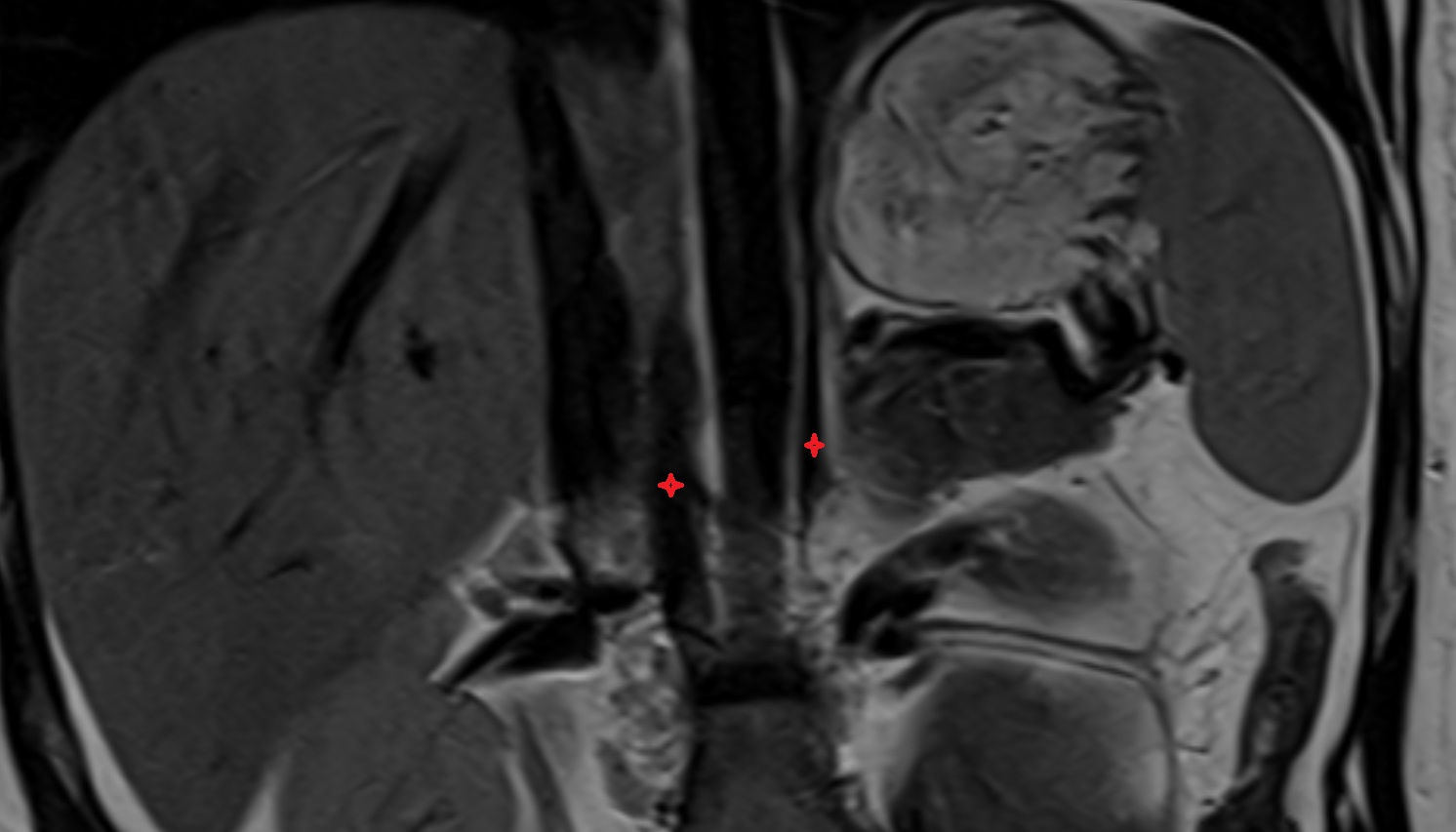 crura of diaphragm  anatomy MRI coronal image -img-00000-00000