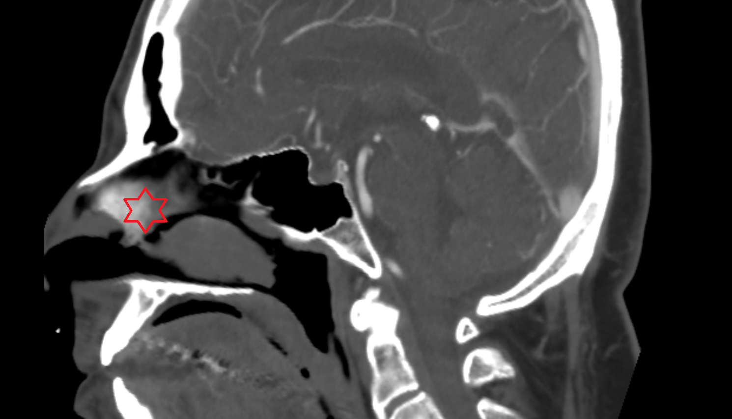 ct Bony nasal septum  anatomy image -img-00000-00000