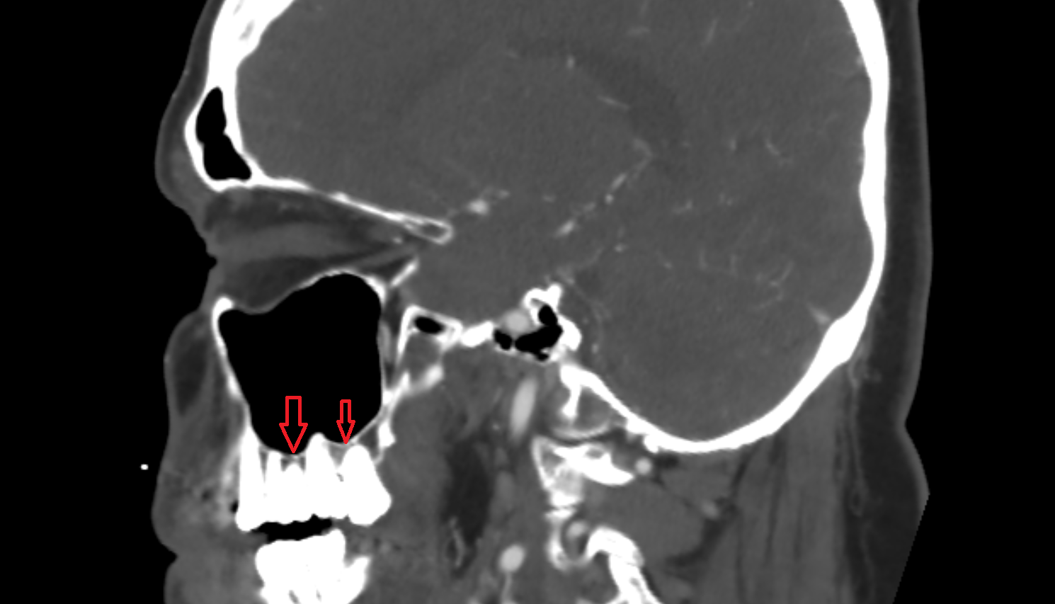 ct Inferior wall of maxillary sinus  anatomy image -img-00000-00000