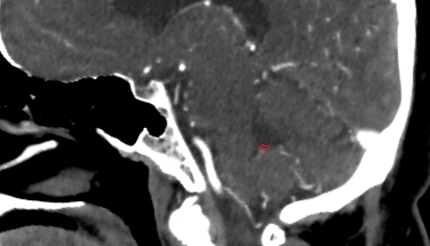 ct  Peduncle of flocculus sag anatomy image -img-00000-00000