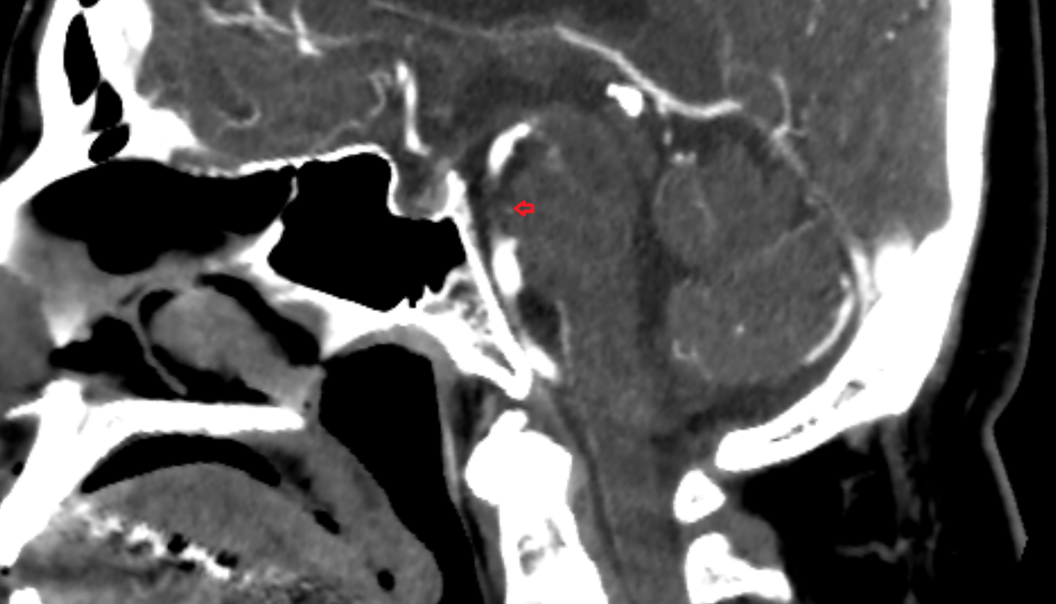 CT Pontine arteries sag anatomy image
