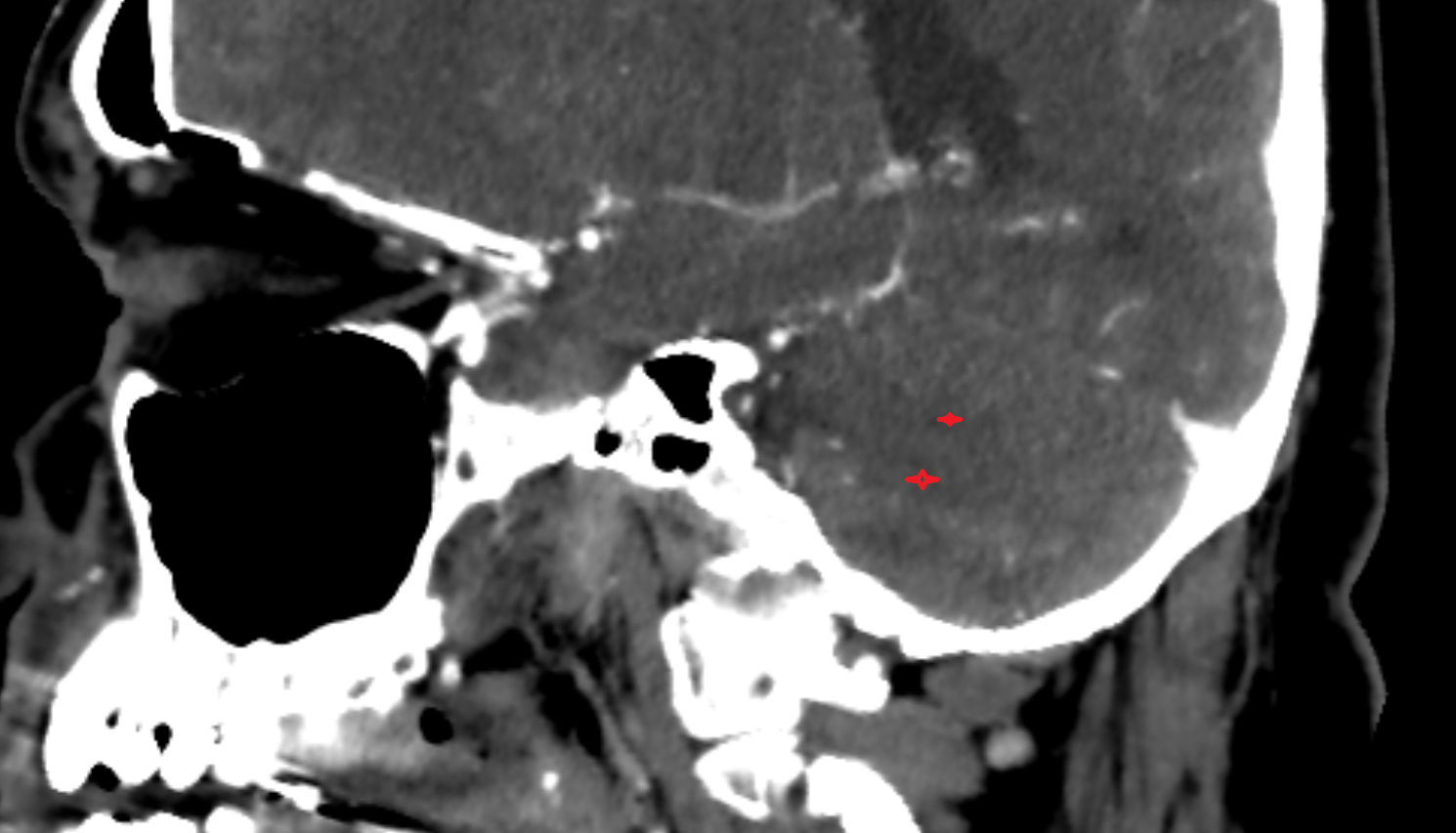 ct White substance of cerebellum sag anatomy image -img-00000-00000