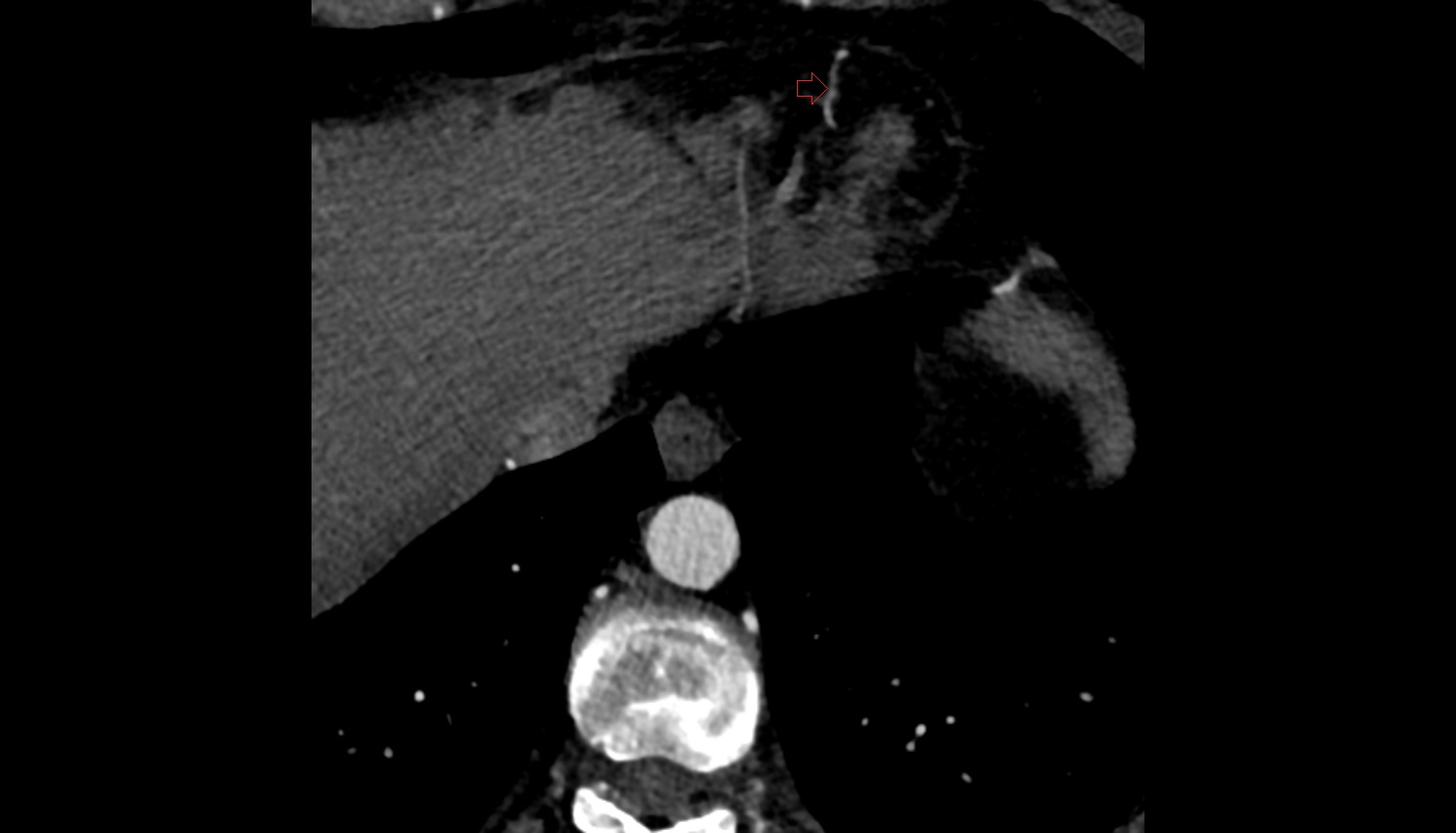 (dLAD) ct axial  anatomy  image -img-00000-00000