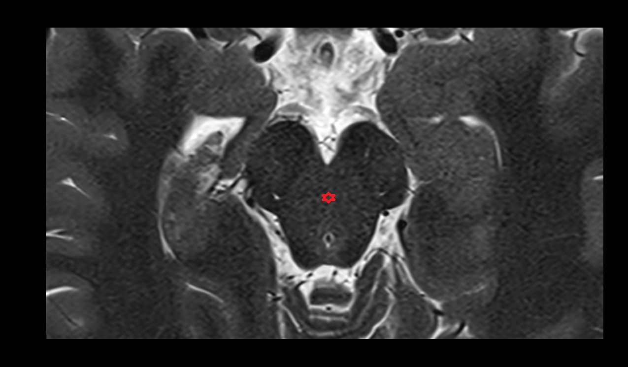 decussation of superior cerebellar peduncles mri 3t axial image