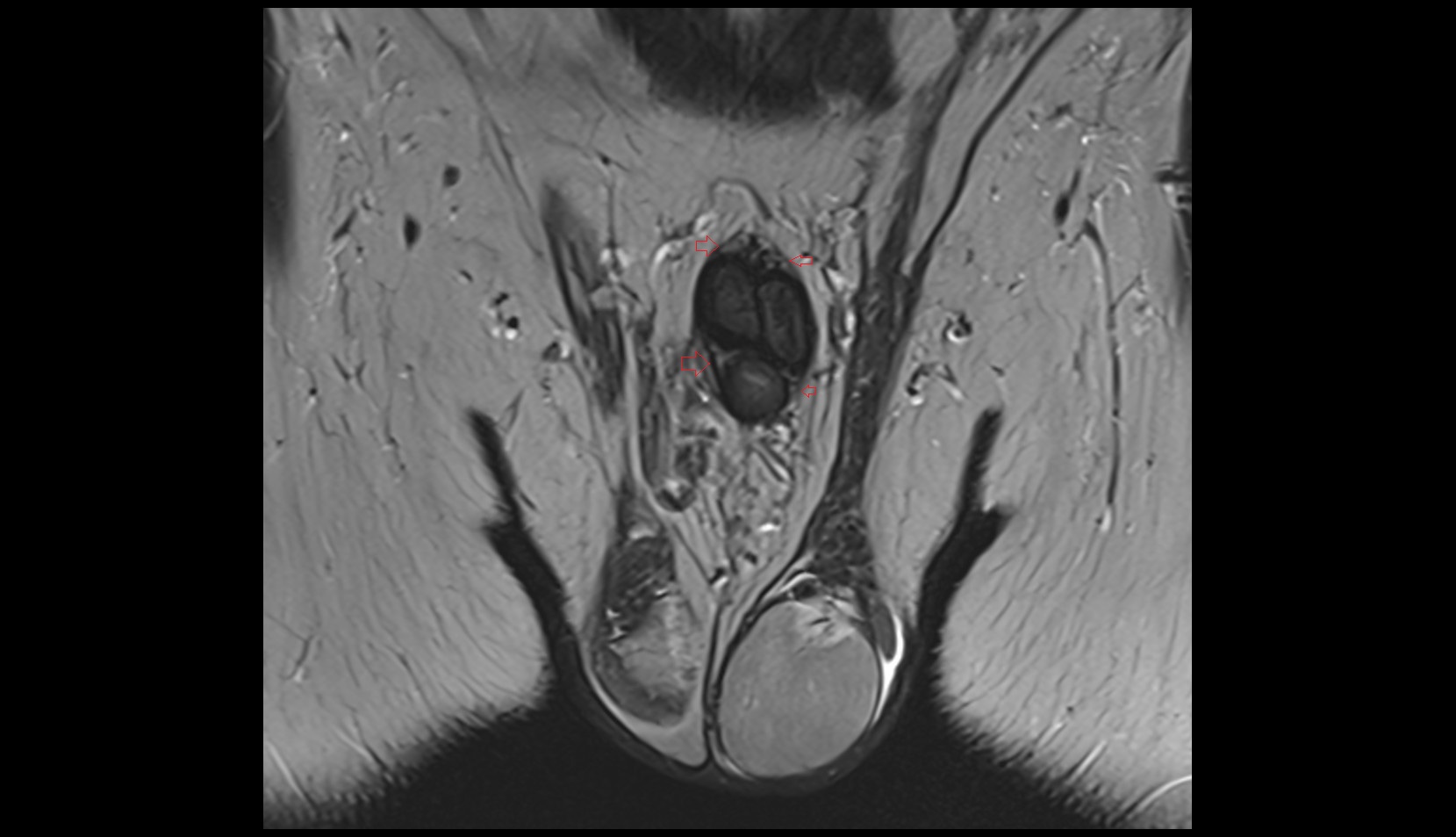Deep fascia (Buck's fascia) MRI coronal image