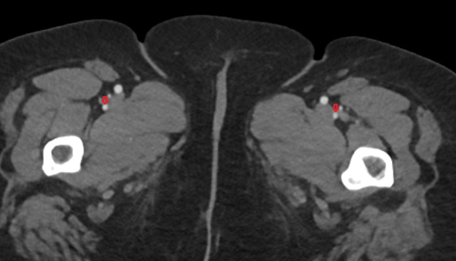 deep femoral artery (profunda femoris)  CT axial image  MRI  axial  anatomy  image-img-00000-00000