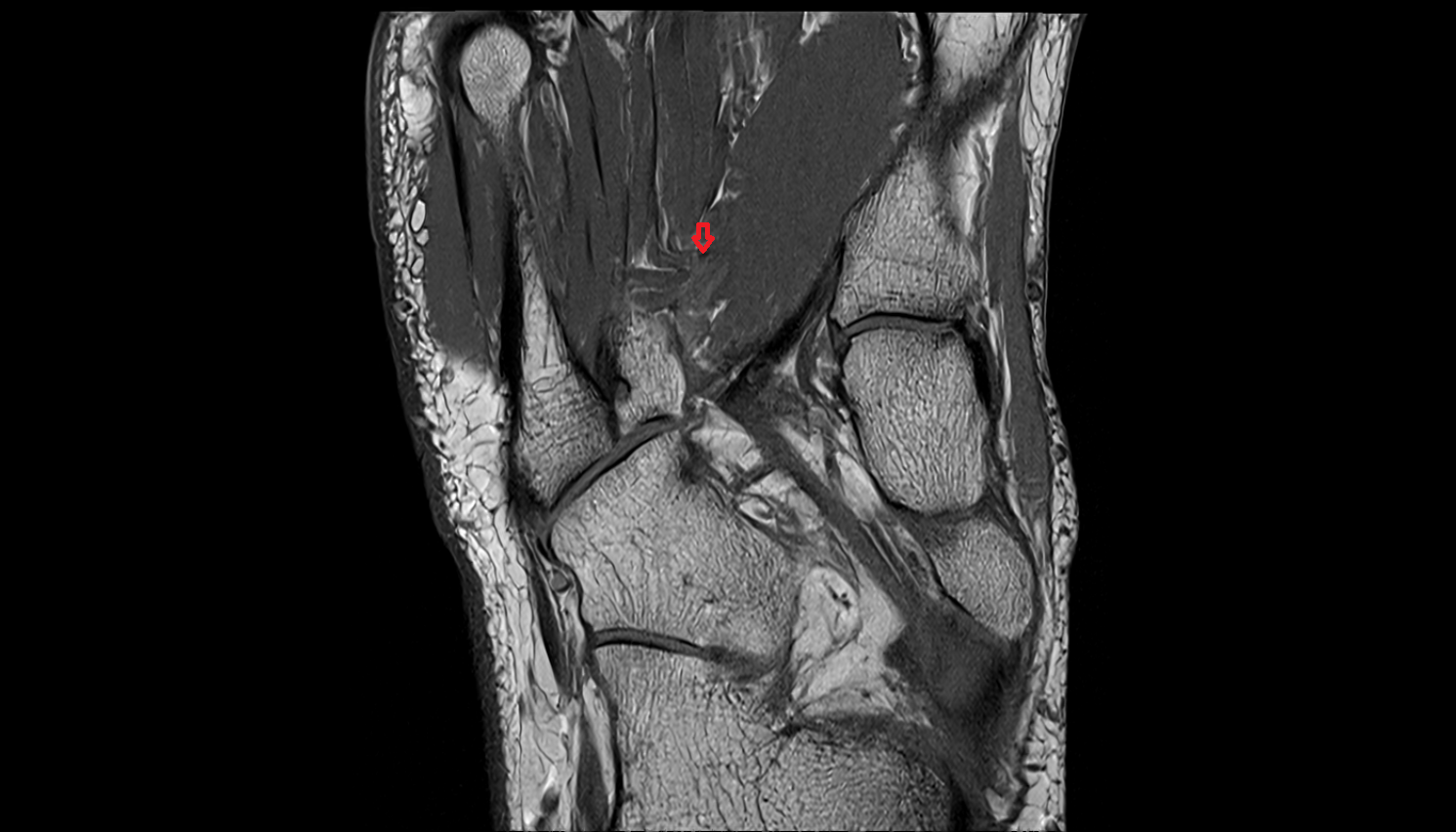 deep plantar arterial arch coronal cross sectional anatomy 3T MRI AI enhanced radiology image-img-00000-00000