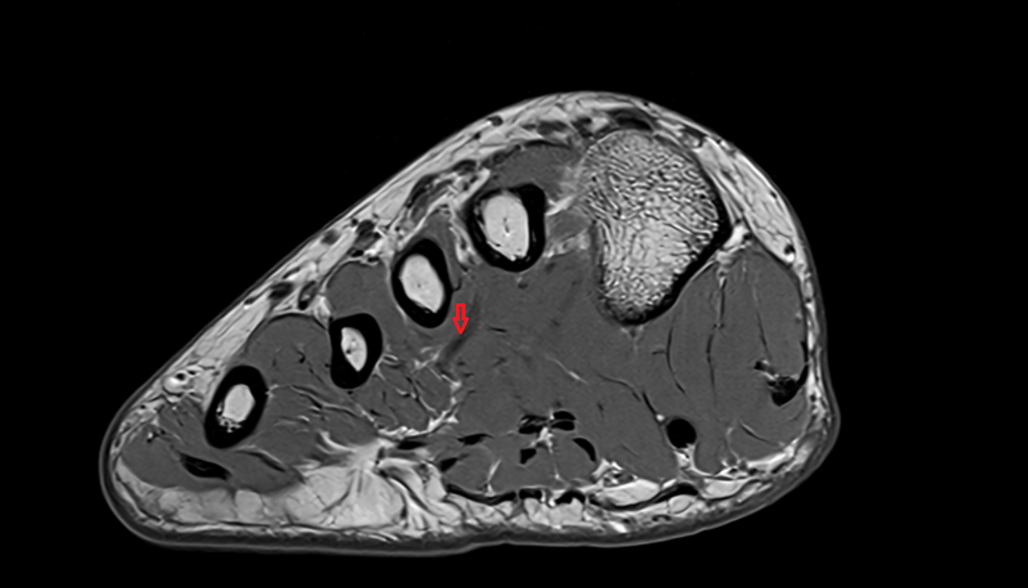 deep plantar arterial arch coronal cross sectional anatomy 3T MRI AI enhanced radiology image-img-00000-00000_00001