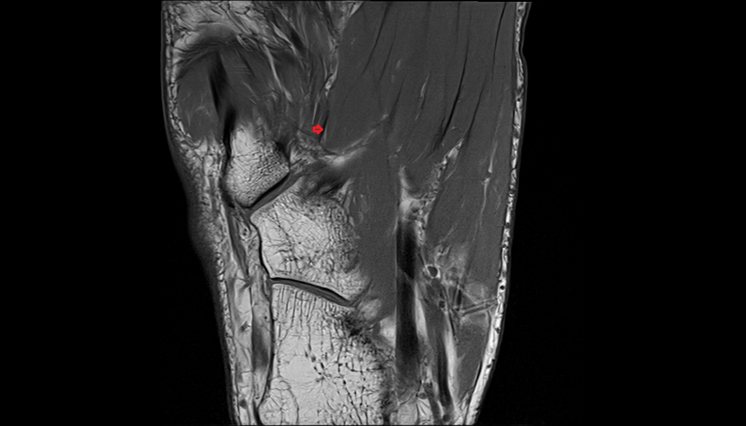 deep plantar arterial arch coronal cross sectional anatomy 3T MRI AI enhanced radiology image-img-00000-00000_00002