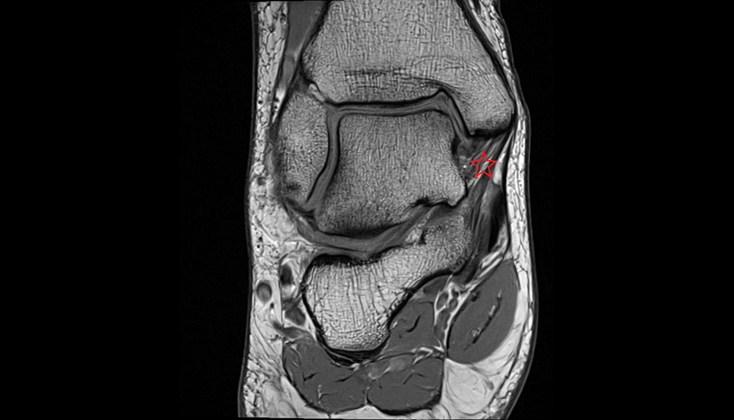 deltoid ligament complex  coronal cross sectional anatomy 3T MRI AI enhanced radiology image-img-00000-00000