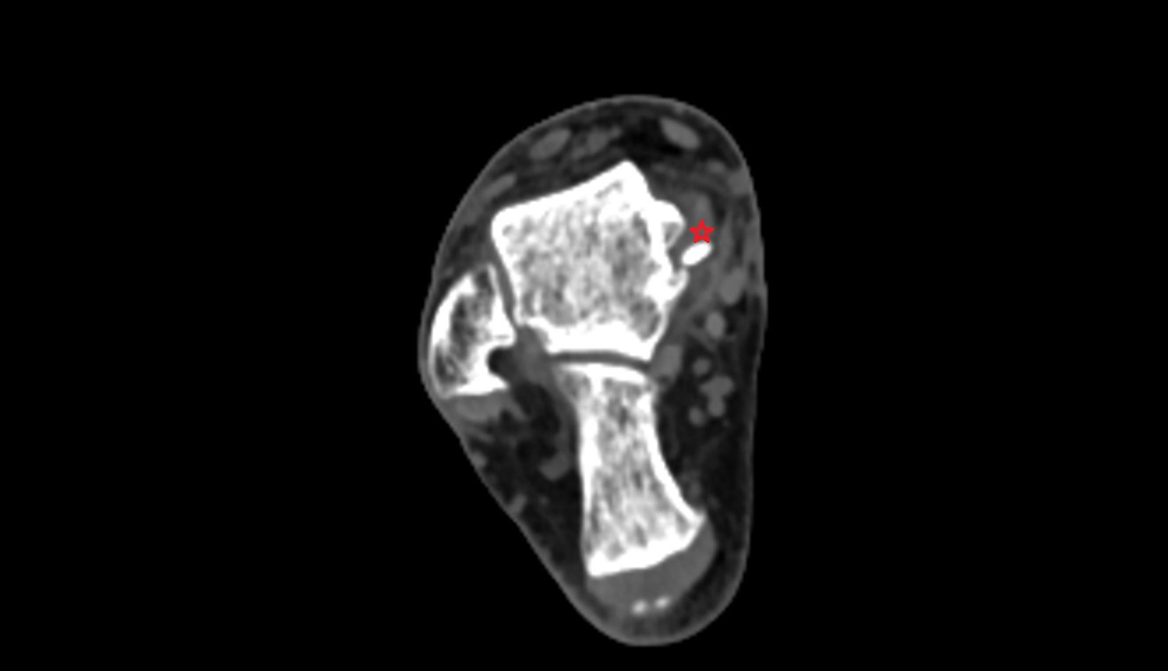 deltoid ligament complex ct axial