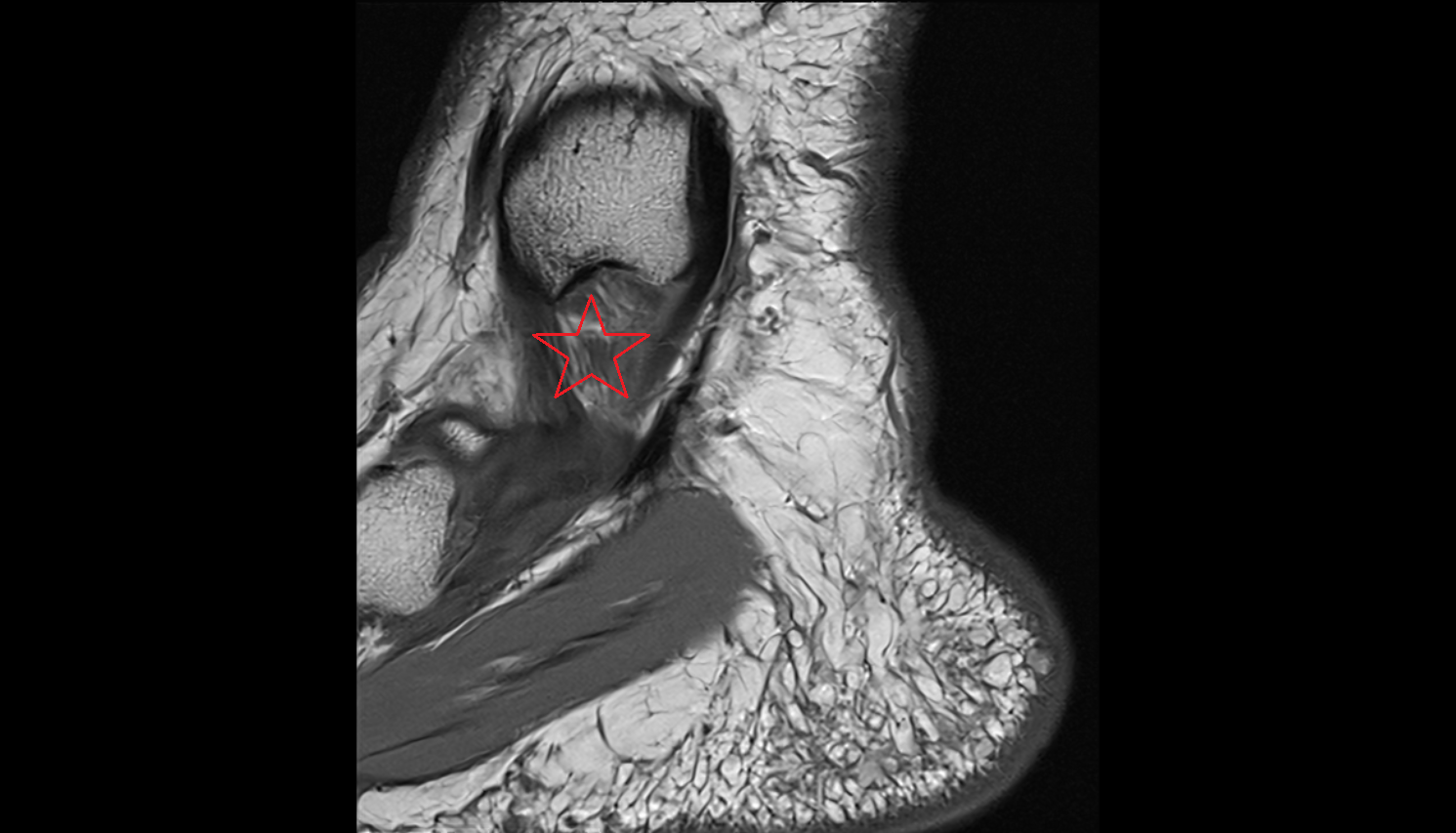 deltoid ligament complex  sagittal cross sectional anatomy 3T MRI AI enhanced radiology image-img-00000-00000