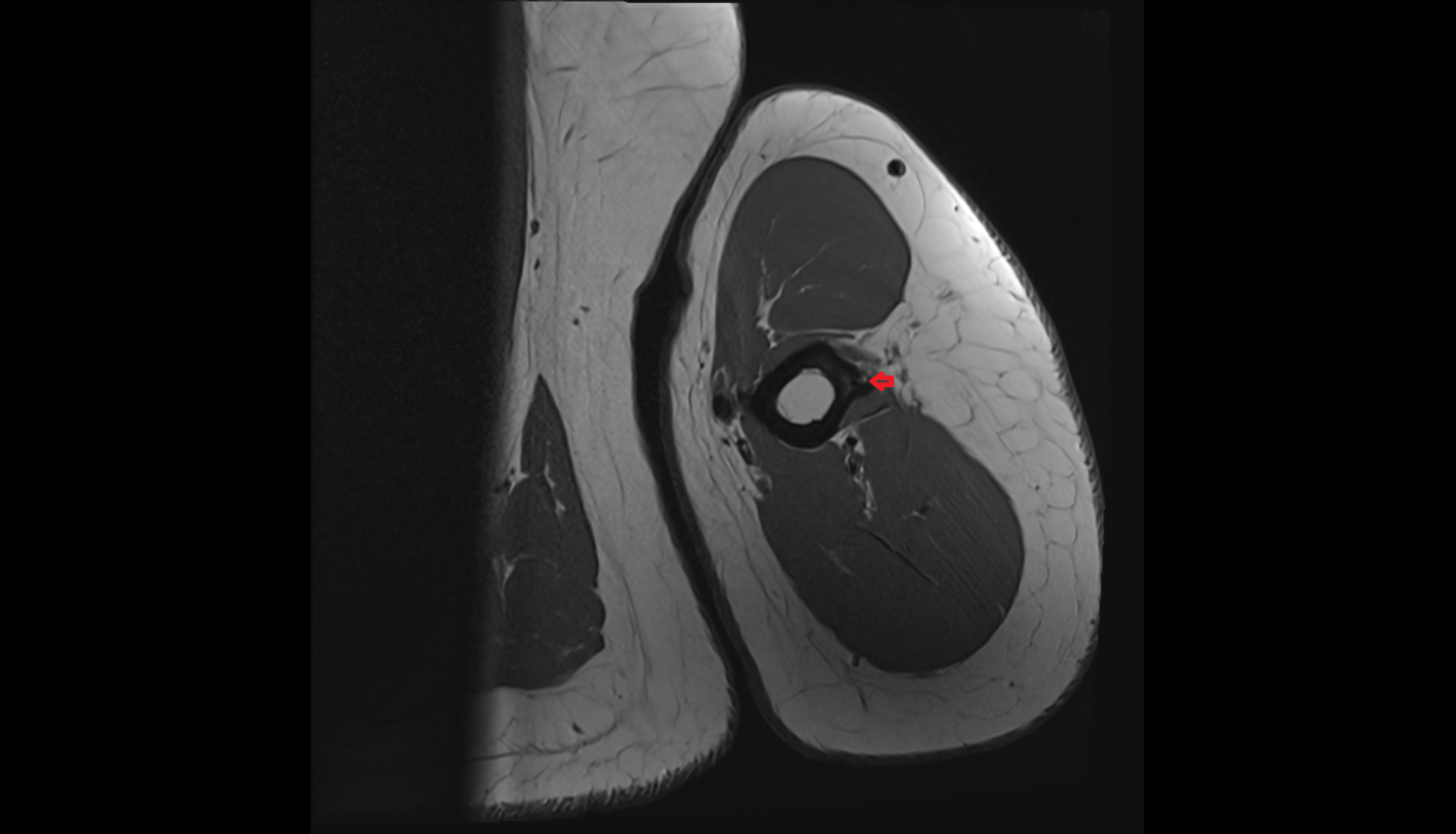 deltoid tuberosity axial cross sectional anatomy 3T MRI AI enhanced radiology image -img-00000-00000