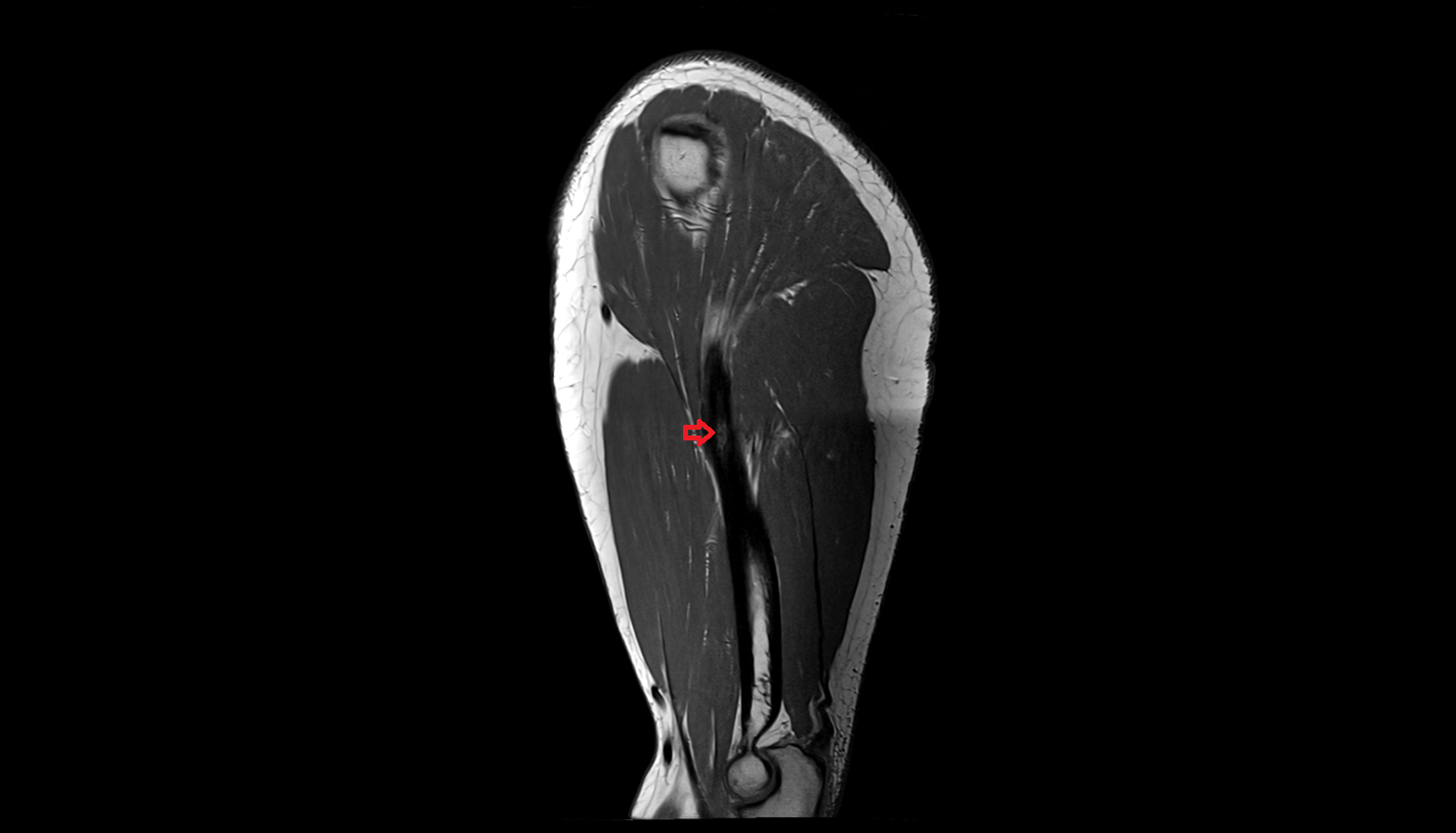 deltoid tuberosity sag cross sectional anatomy 3T MRI AI enhanced radiology image -img-00000-00000
