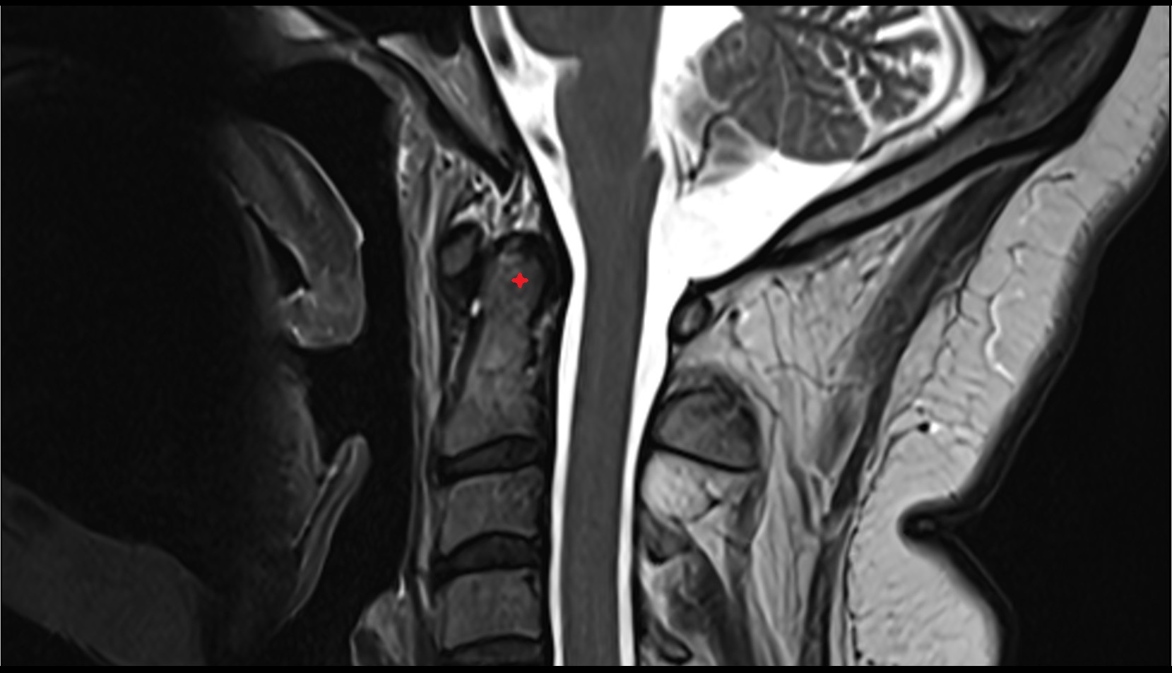 dens of axis sagittal image
