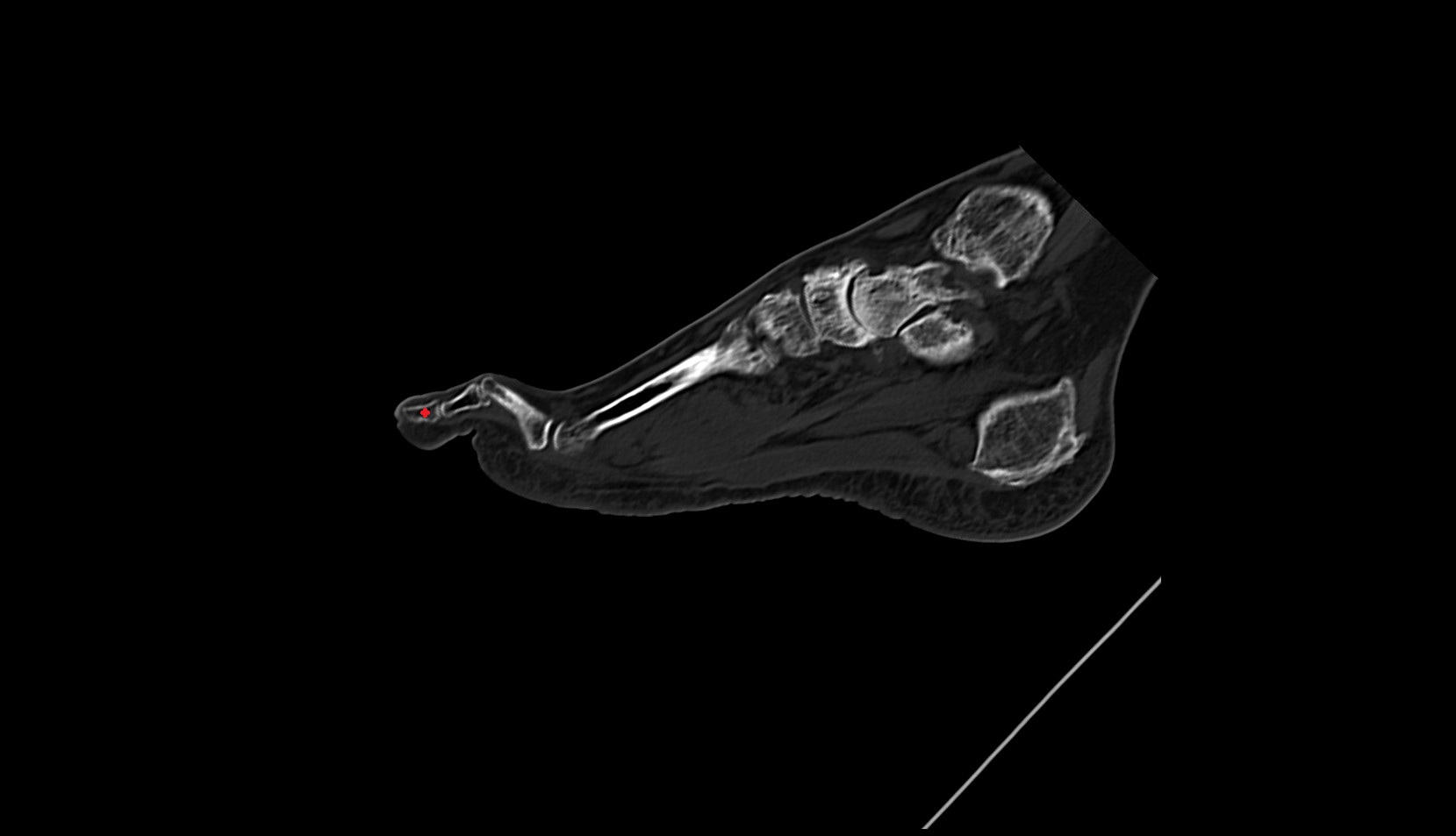 distal phalanx OF FOOT SAG CT IMAGE