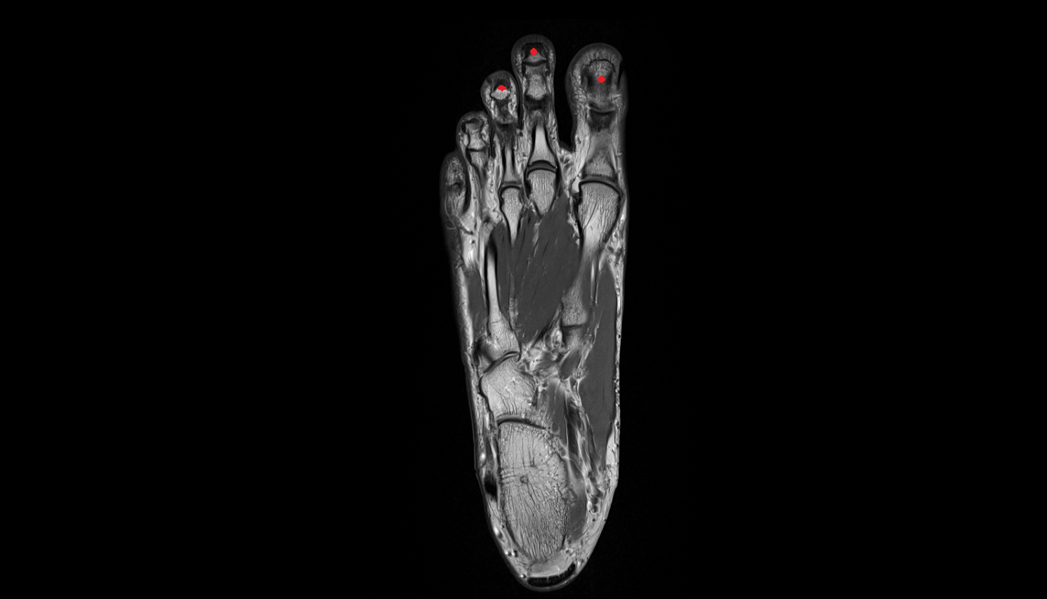 distal phalanx foot SAG cross sectional anatomy 3T MRI AI enhanced radiology image-img-00000-00000