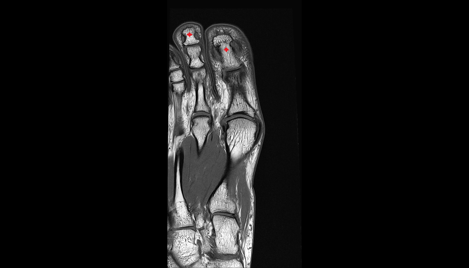 distal phalanx foot coronal cross sectional anatomy 3T MRI AI enhanced radiology image-img-00000-00000