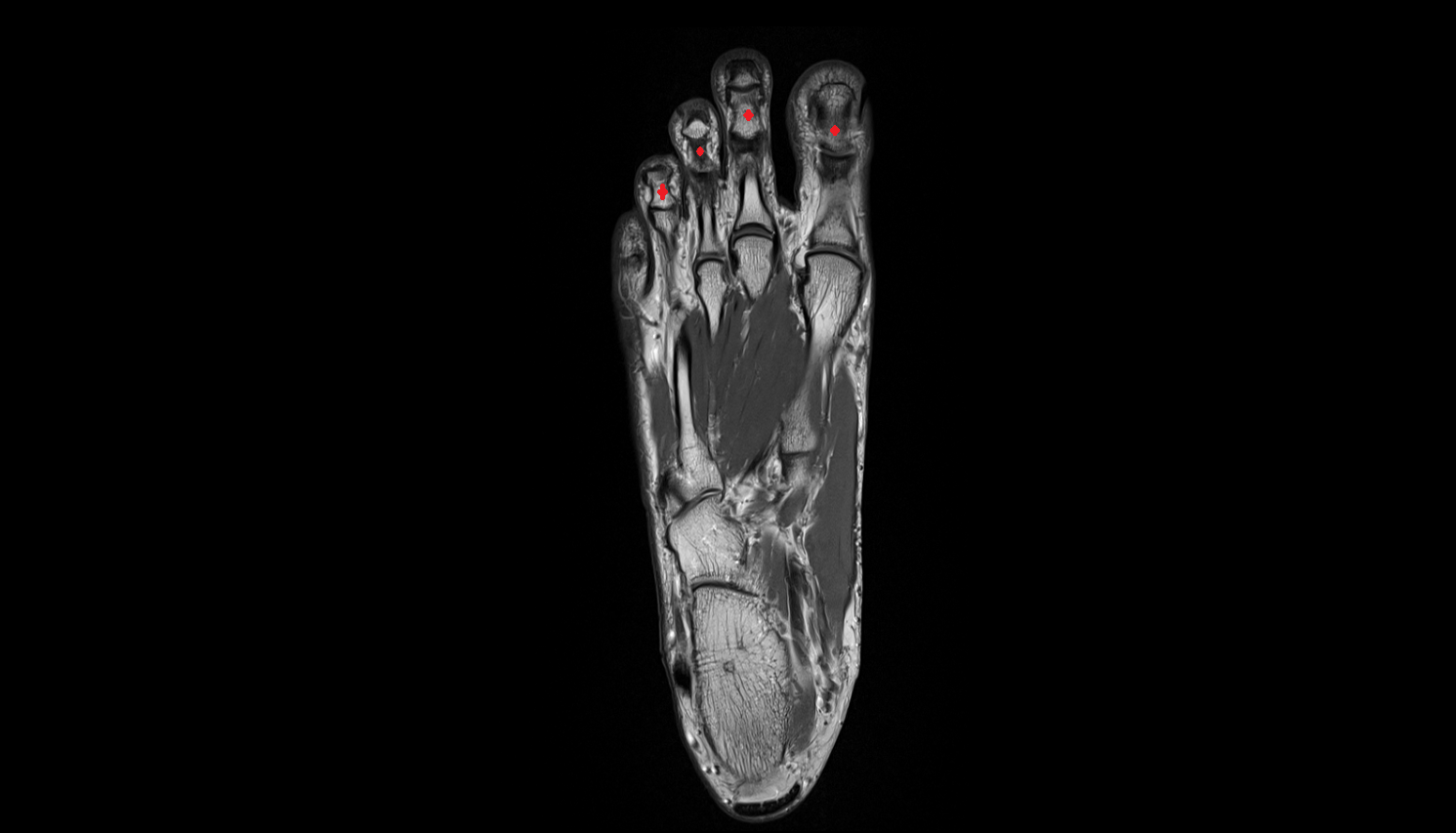 distal phalanx foot coronal cross sectional anatomy 3T MRI AI enhanced radiology image-img-00000-00000_00001