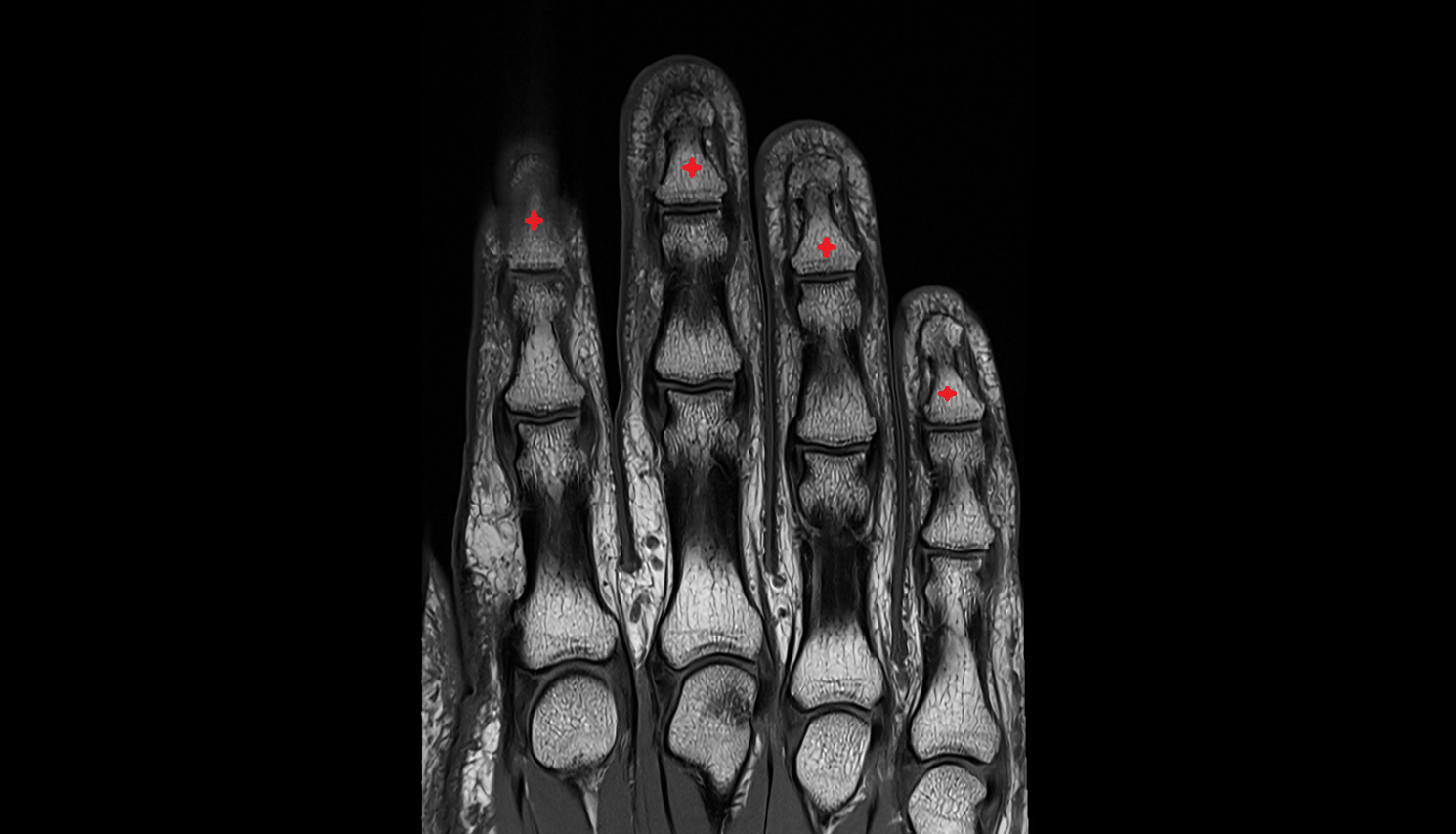 distal phalanx of hand coronal cross sectional anatomy 3T MRI AI enhanced radiology image-img-00000-00000