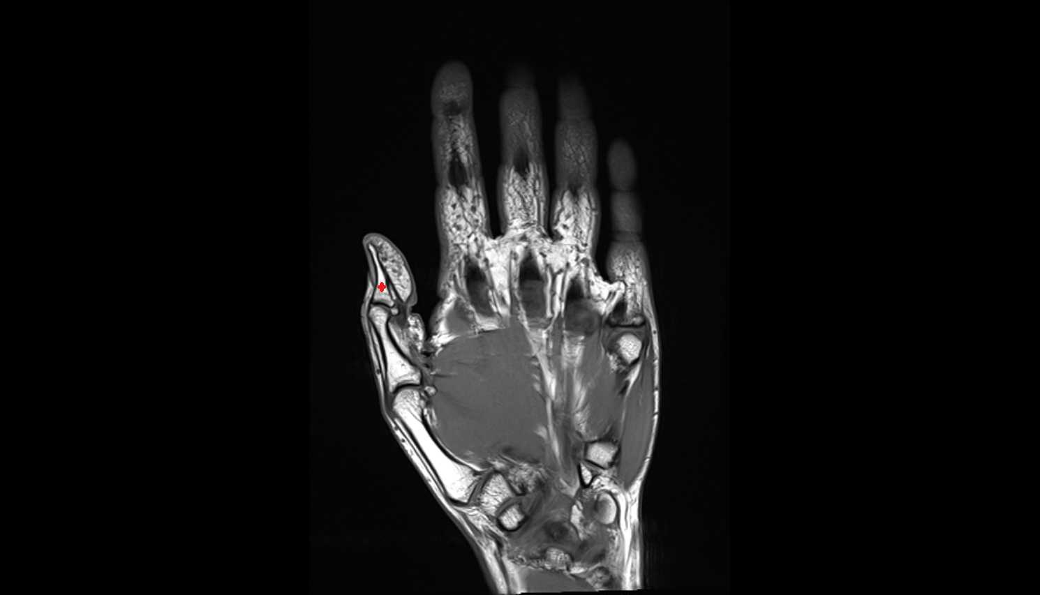distal phalanx of hand coronal cross sectional anatomy 3T MRI AI enhanced radiology image-img-00000-00000_00001