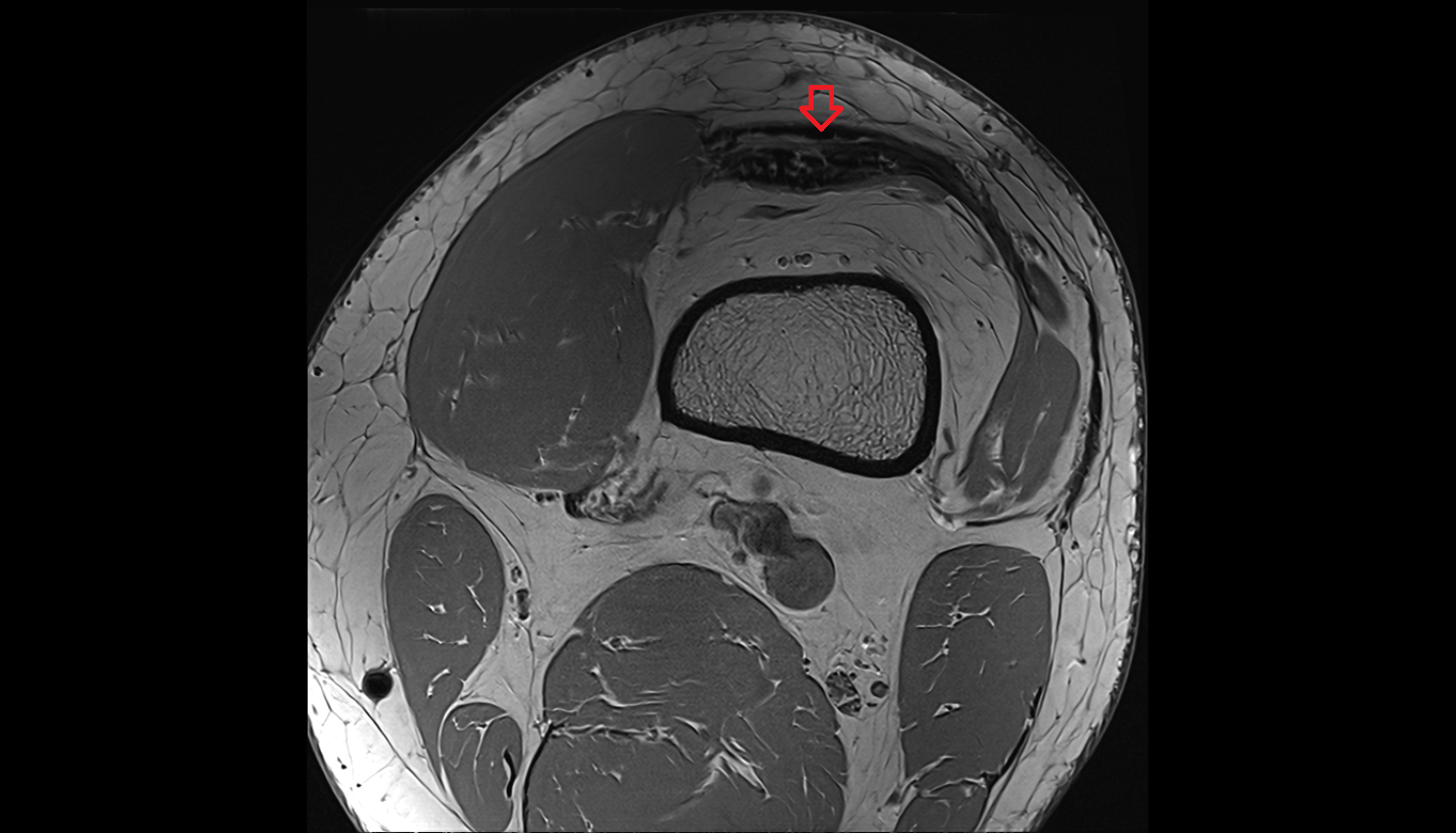 distal rectus femoris  tendonaxial cross sectional anatomy 3T MRI AI enhanced  radiology  anatomy image-img-00000-00000