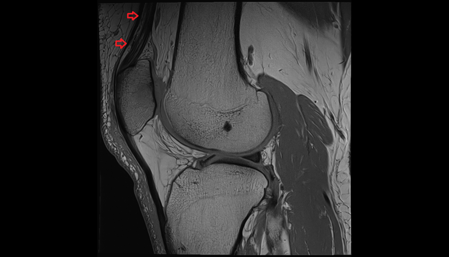 distal rectus femoris  tendon sagittal cross sectional anatomy 3T MRI AI enhanced  radiology  anatomy image-img-00000-00000