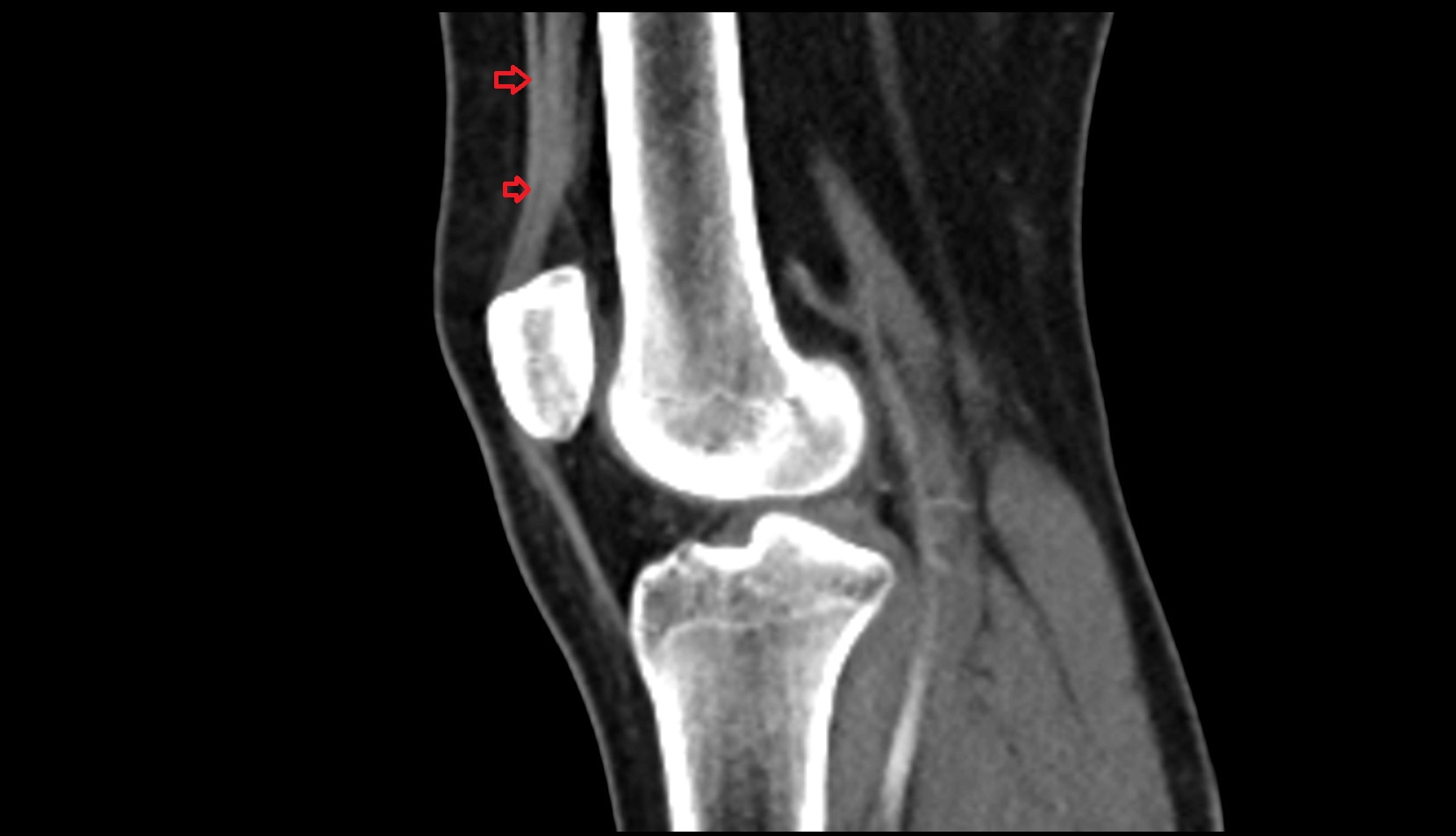 distal rectus femoris  tendon tendon CT sagittal image