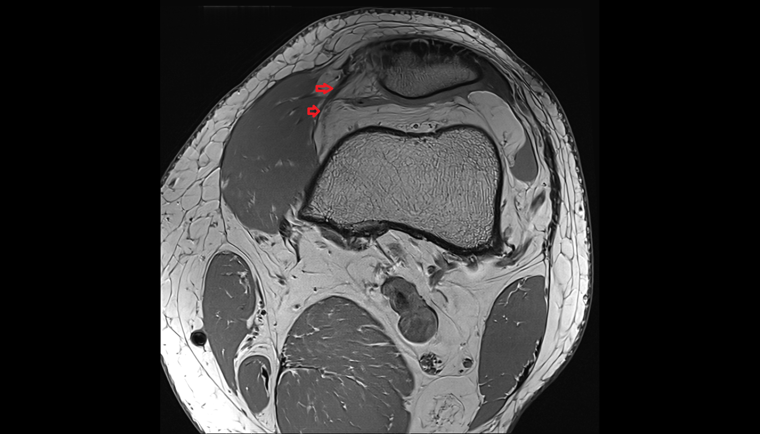 distal vastus medialis tendon axial  cross sectional anatomy 3T MRI AI enhanced  radiology  anatomy image-img-00000-00000