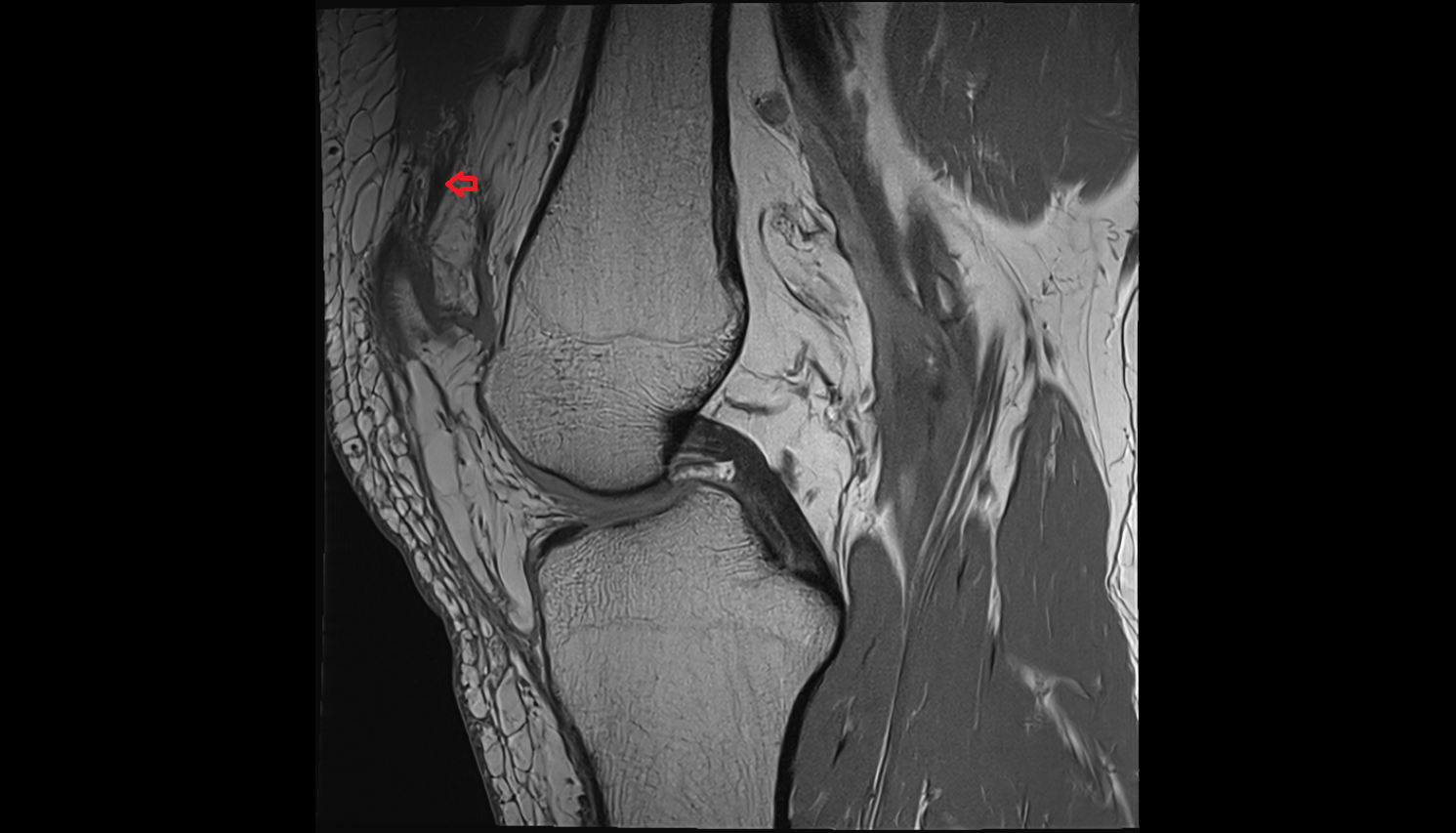 distal vastus medialis tendon sagittal  cross sectional anatomy 3T MRI AI enhanced  radiology  anatomy image-img-00000-00000