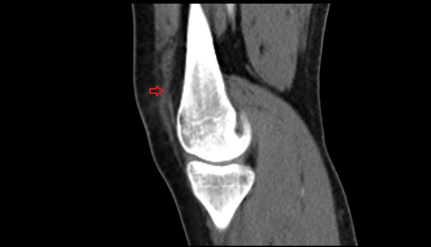 distal vastus medialis tendon sagittal image