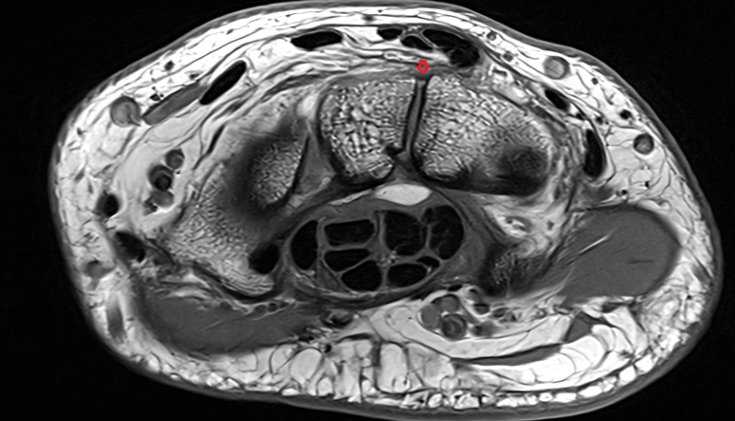dorsal capitohamate ligament  axial cross sectional anatomy 3T MRI AI enhanced radiology image-img-00000-00000
