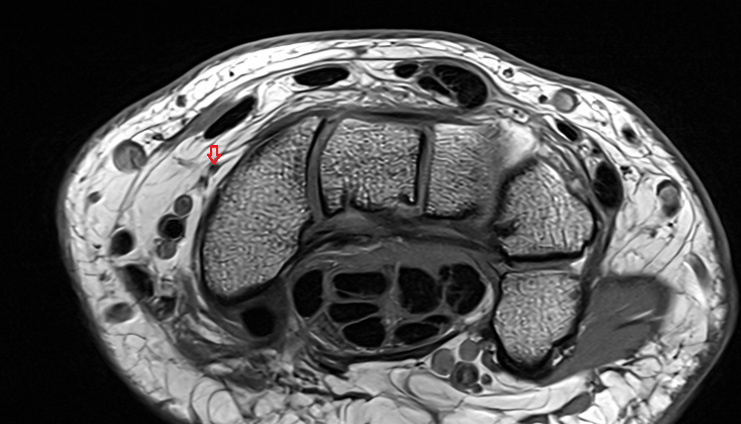 dorsal carpal branch of the radial artery axial cross sectional anatomy 3T MRI AI enhanced radiology image-img-00000-00000